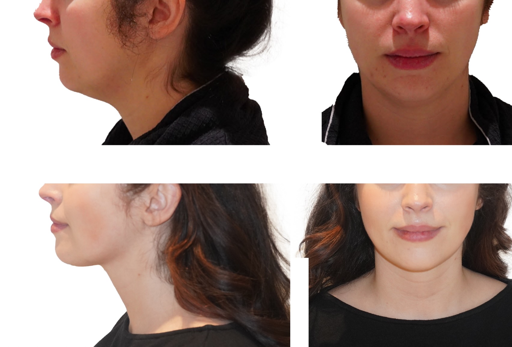 Chin liposuction photographs, Photo 130.