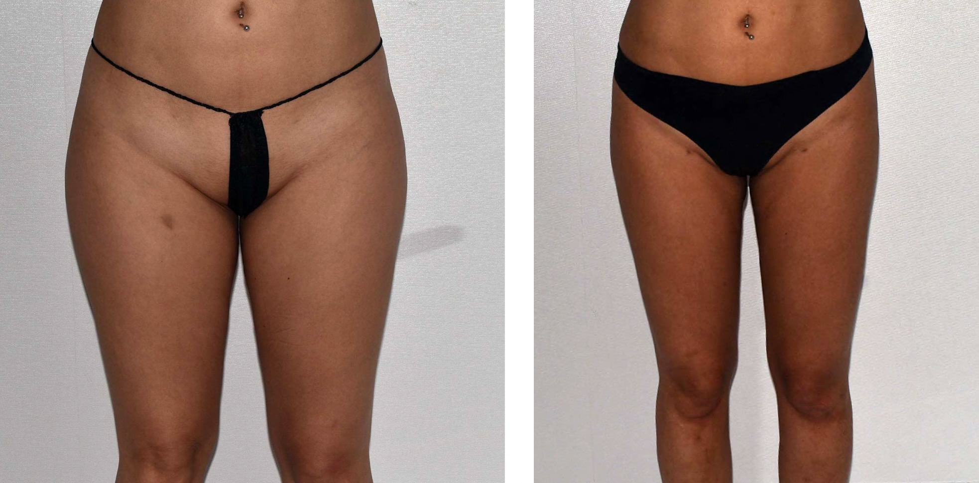 Leg liposuction photographs, Photo 158.