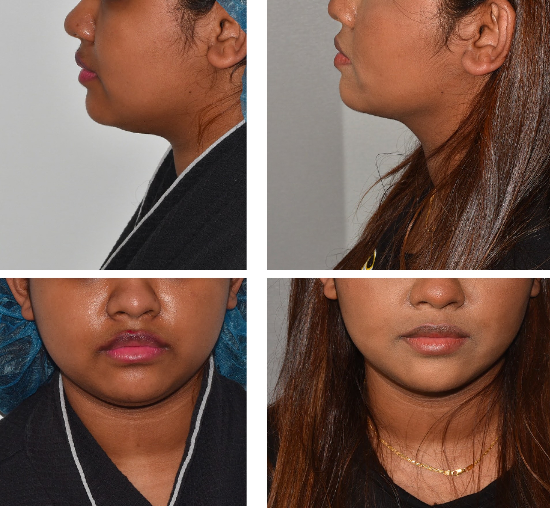 Chin liposuction photographs, Photo 162.