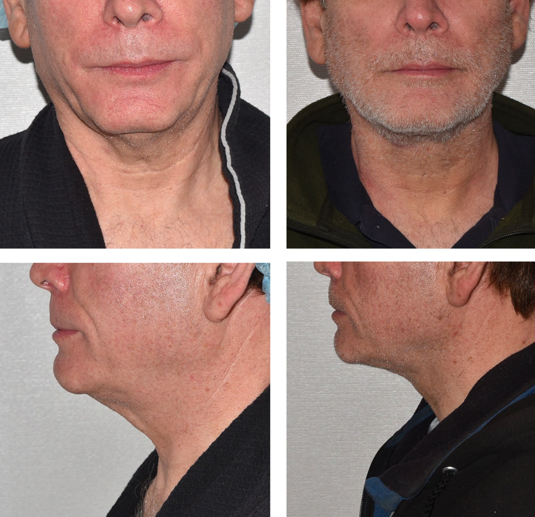 Chin liposuction photographs, Photo 54.