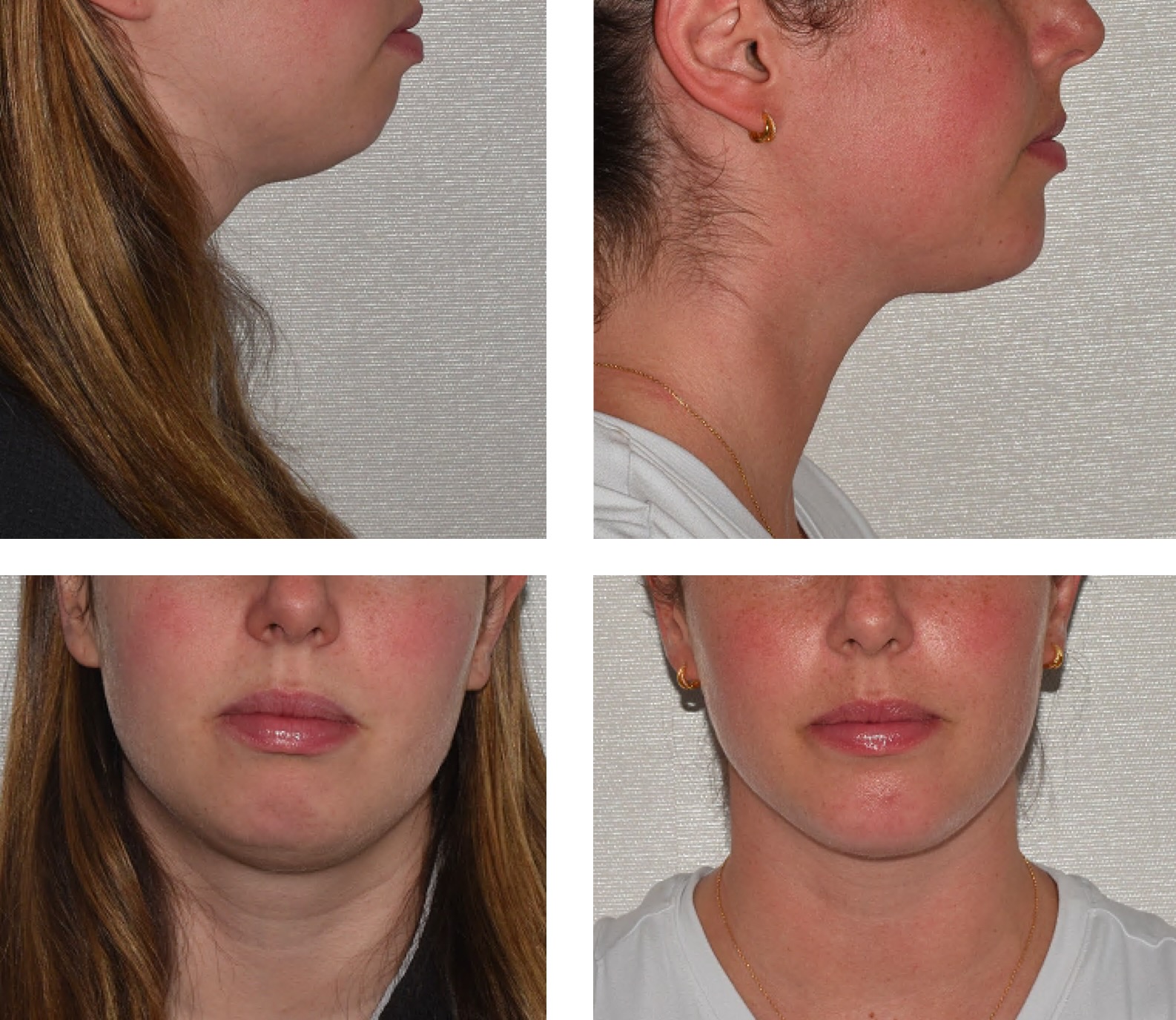 Chin liposuction photographs, Photo 160.