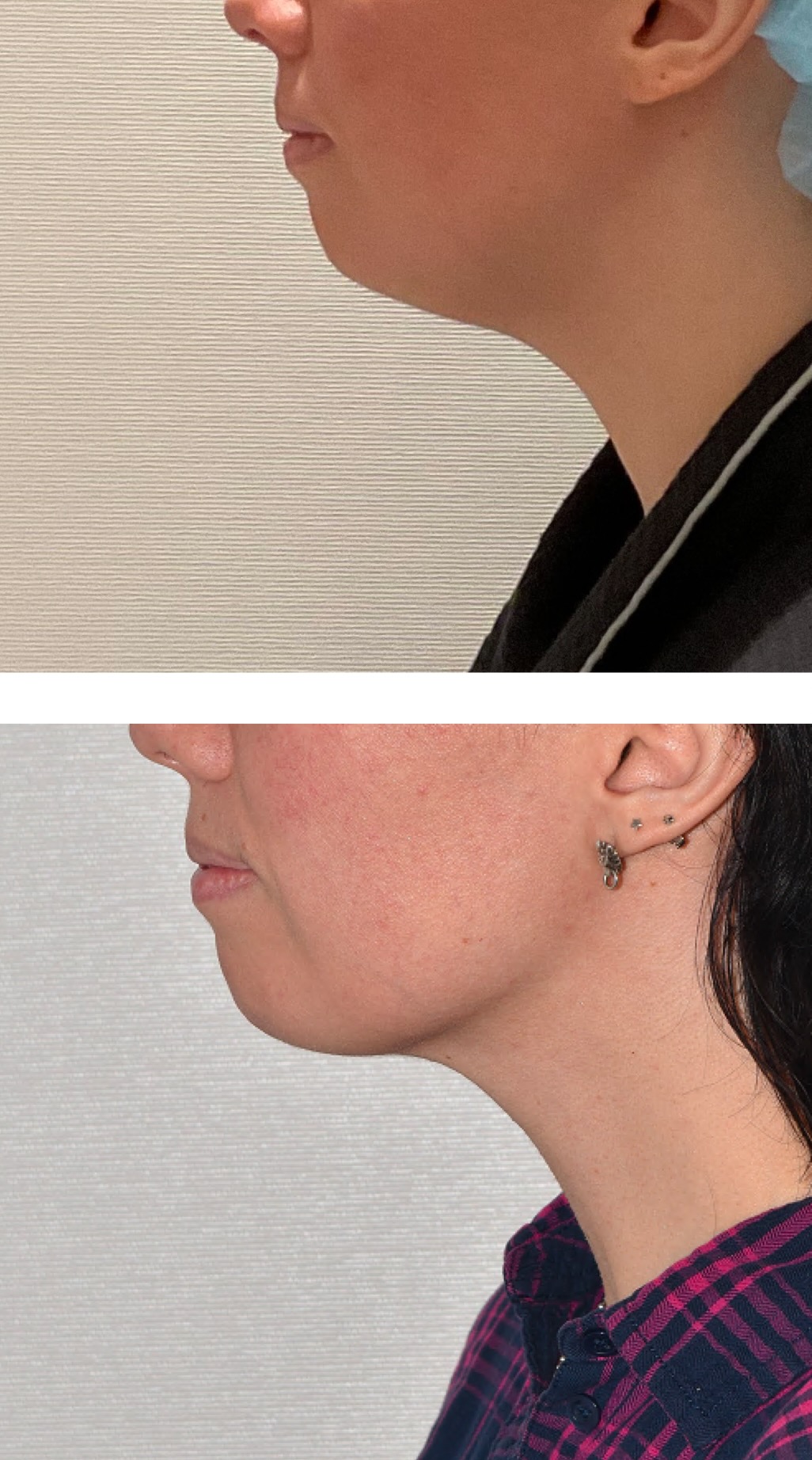 Chin liposuction photographs, Photo 164.