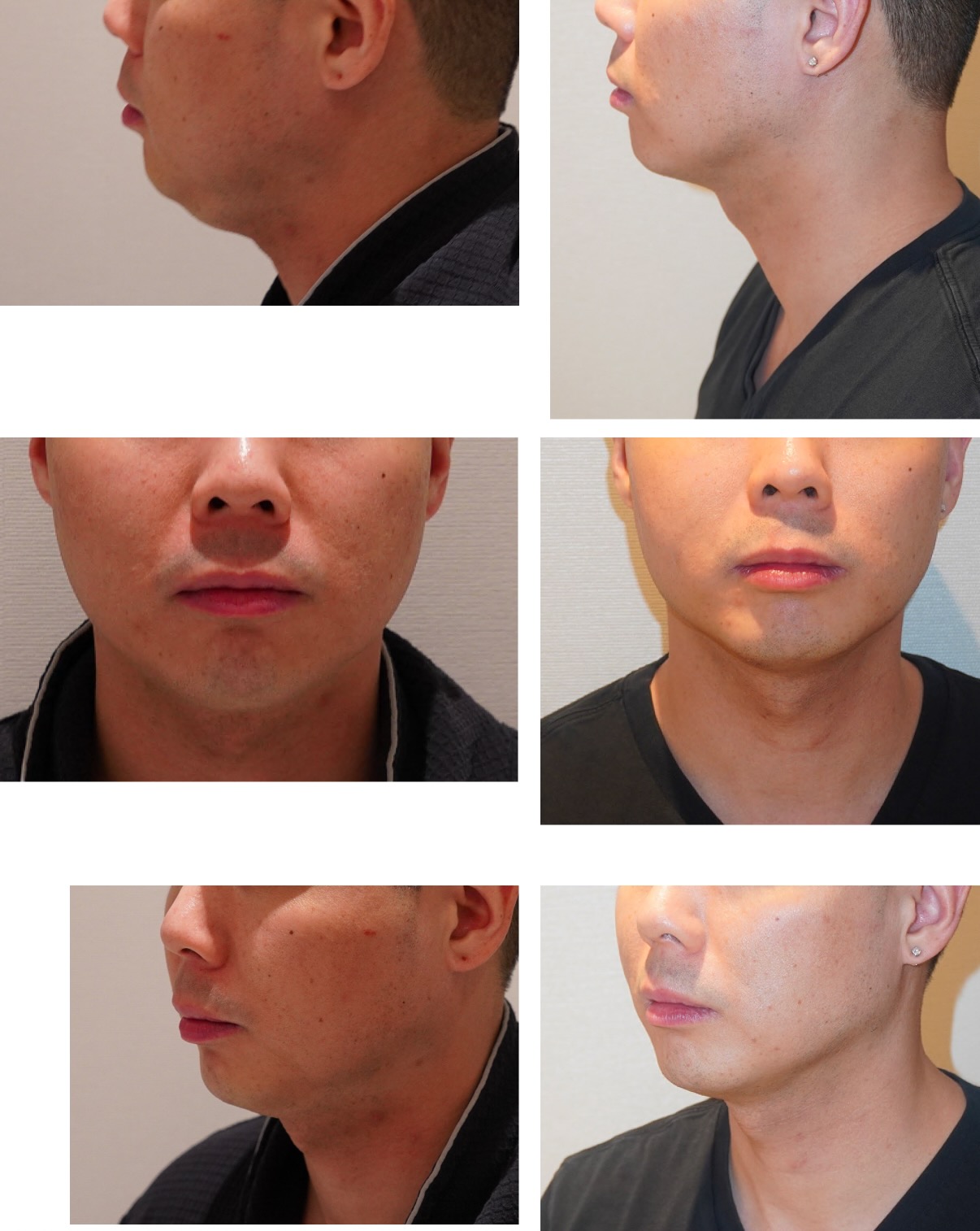 Chin liposuction photographs, Photo 127.