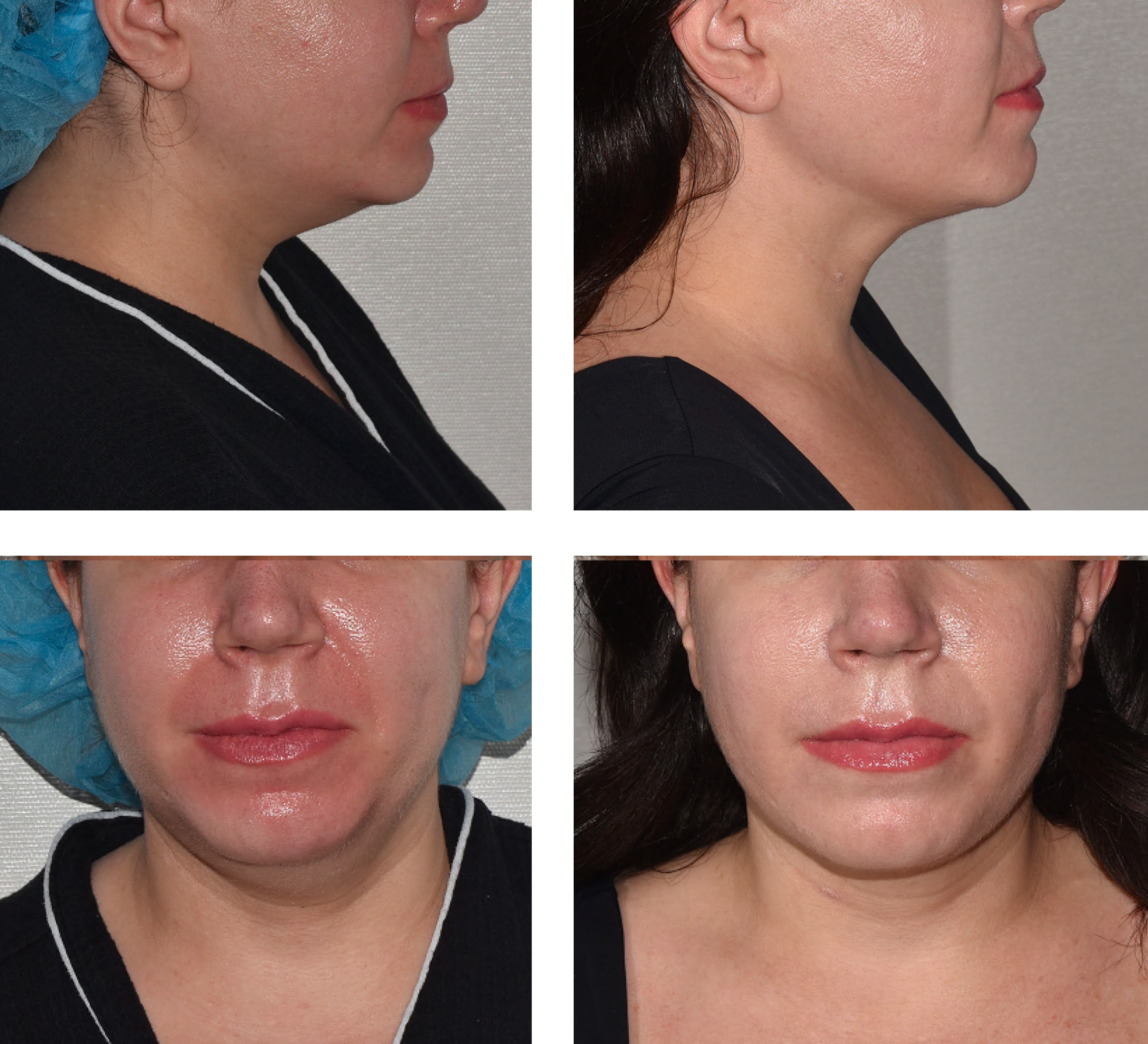 Chin liposuction photographs, Photo 90.