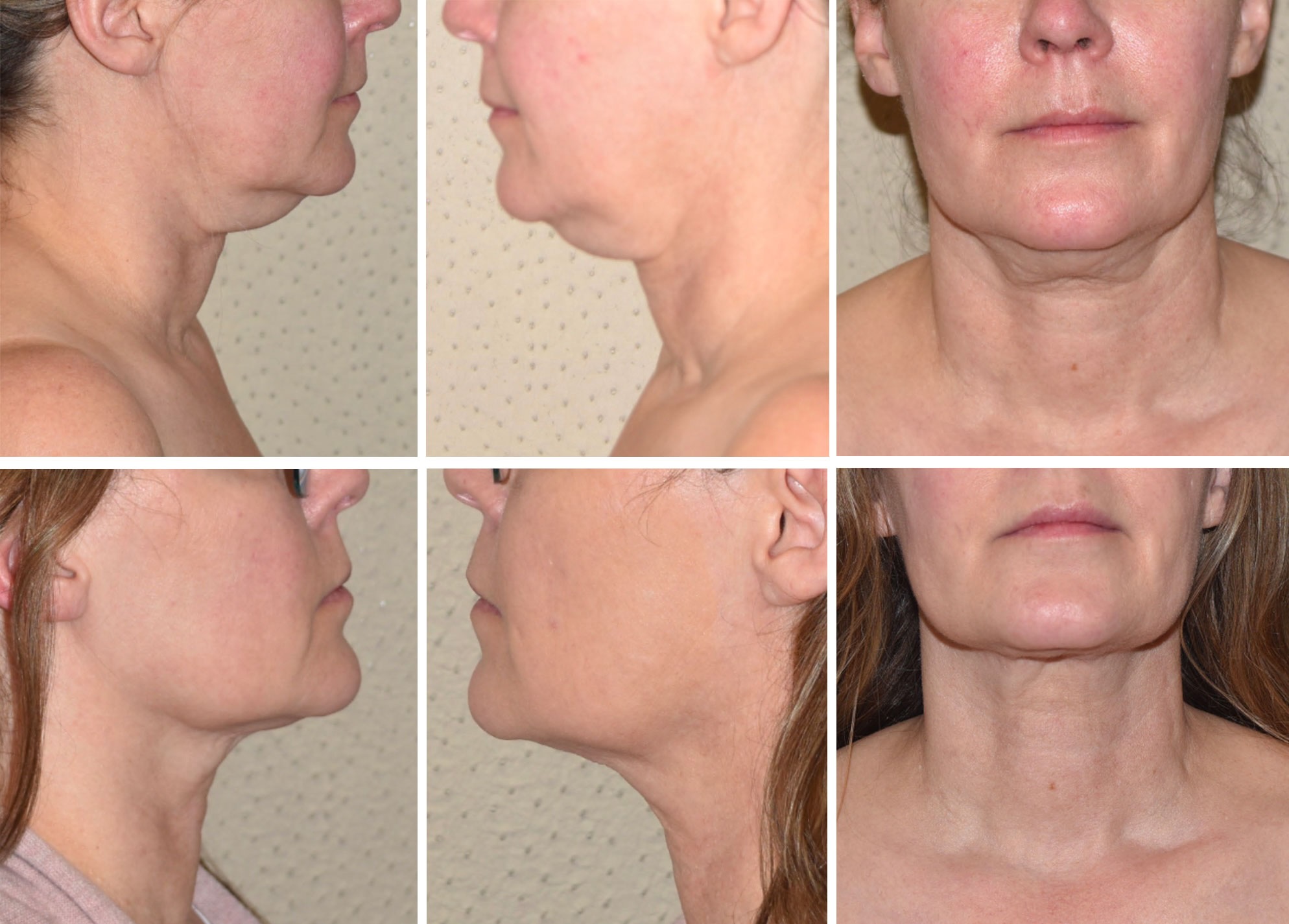 Chin liposuction photographs, Photo 175.