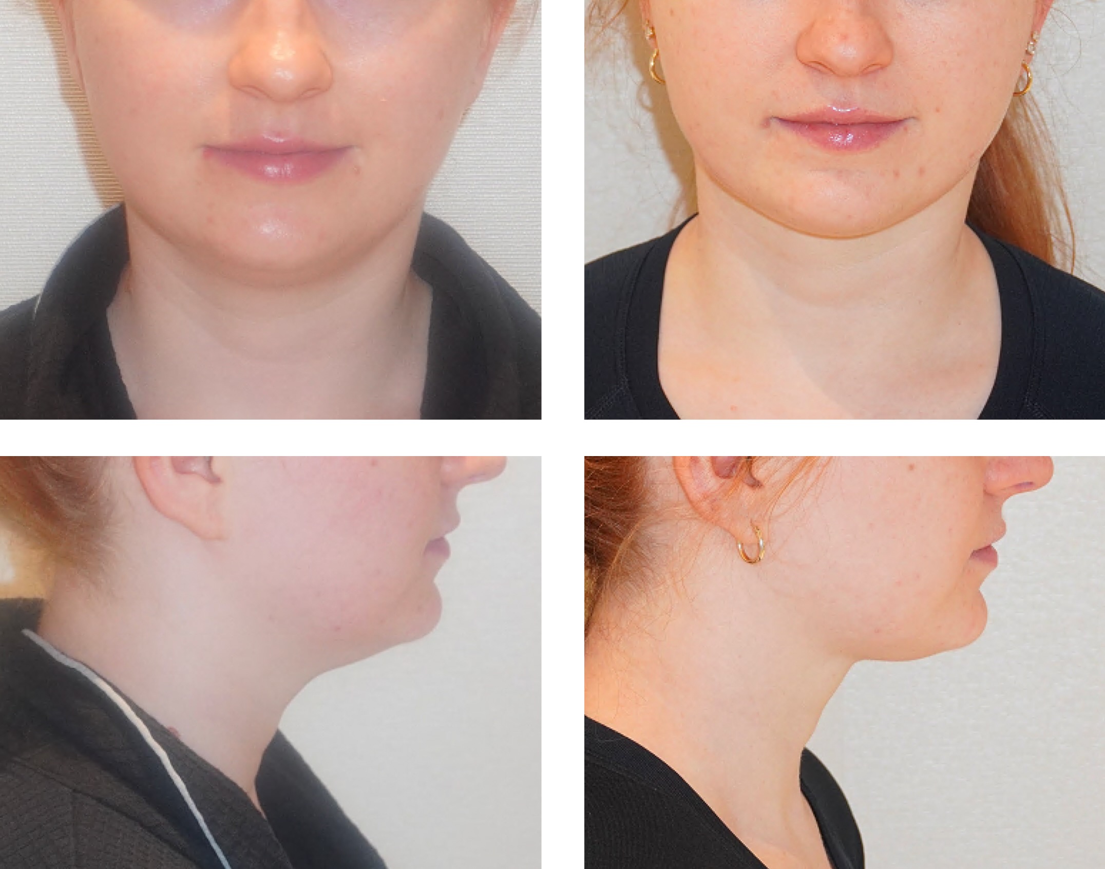 Chin liposuction photographs, Screenshot 2025-12-02 at 4.26.32 PM.