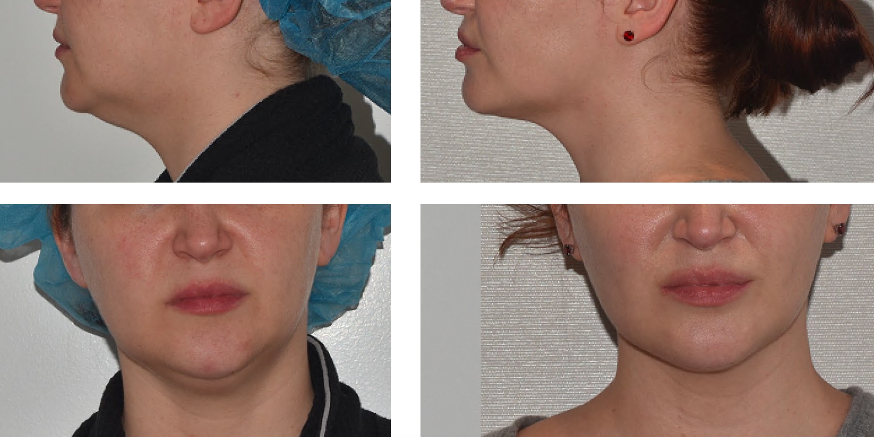 Chin liposuction photographs, Photo 170.