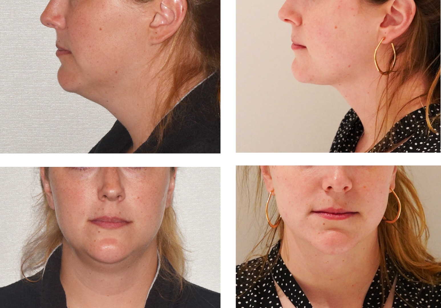 Chin liposuction photographs, Screenshot 2025-10-28 at 6.41.36 PM.