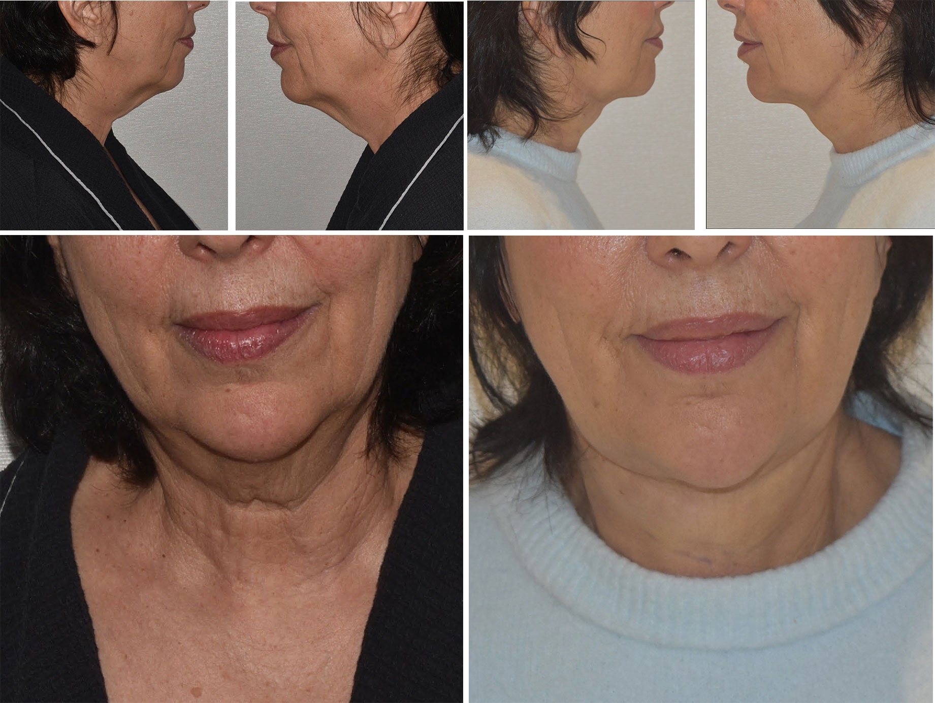 Chin liposuction photographs, Photo 176.