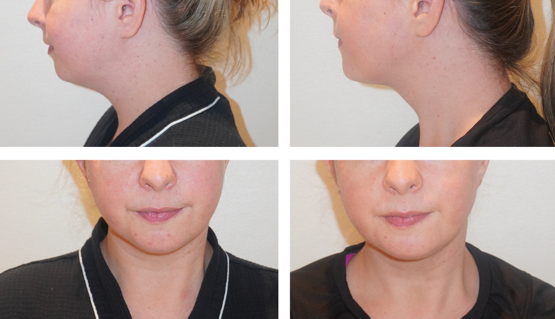 Chin liposuction photographs, Screenshot 2025-12-11 at 4.48.06 PM.
