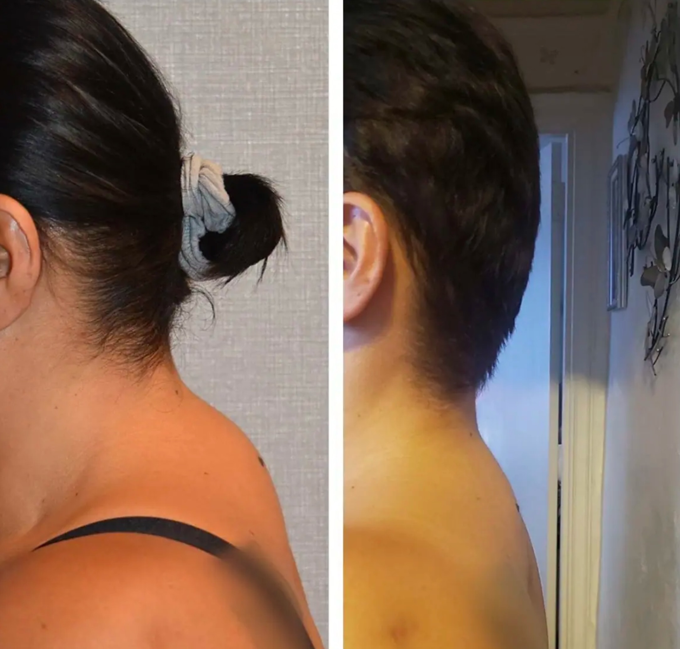 Dorsal Cervical Fat Pad (Buffalo Hump) photographs, Photo 148.
