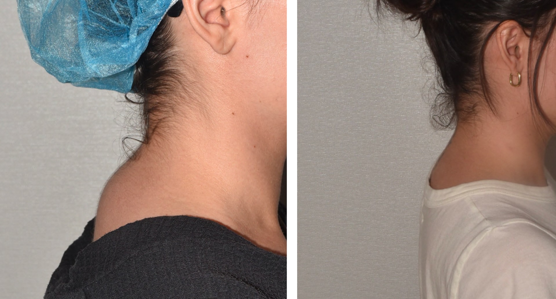 Dorsal Cervical Fat Pad (Buffalo Hump) photographs, Photo 147.