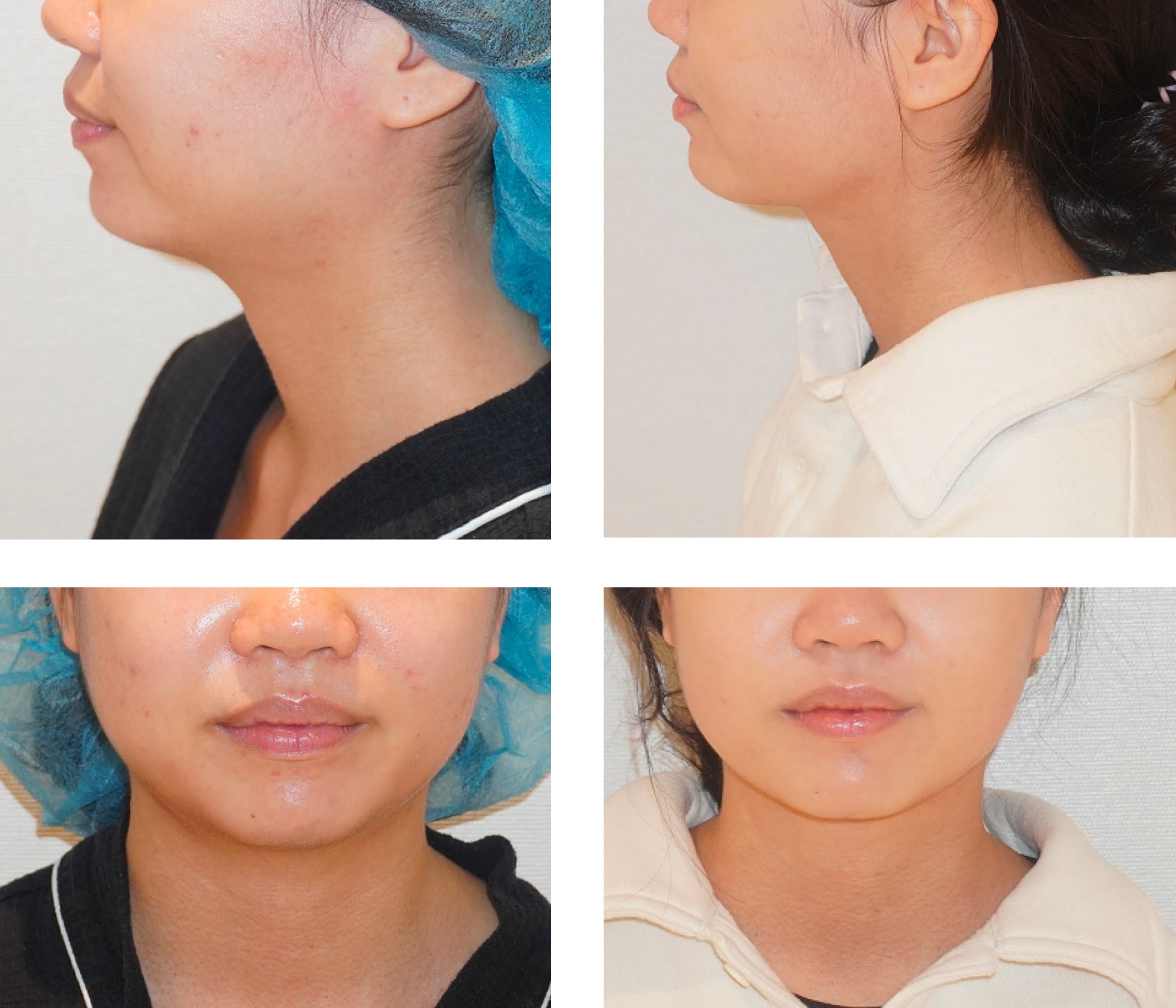 Chin liposuction photographs, Screenshot 2025-12-09 at 9.12.28 AM.