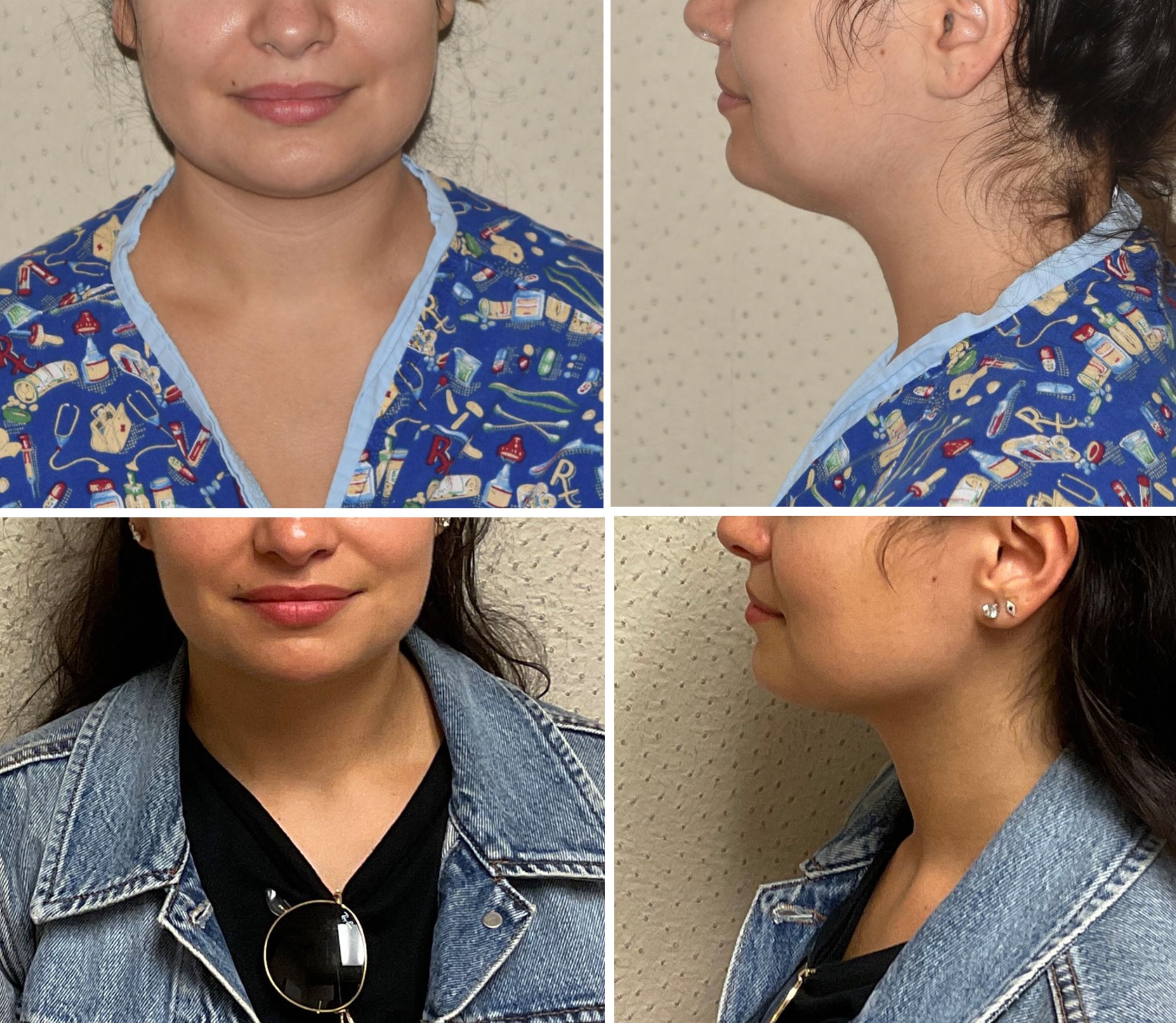 Chin liposuction photographs, Photo 171.