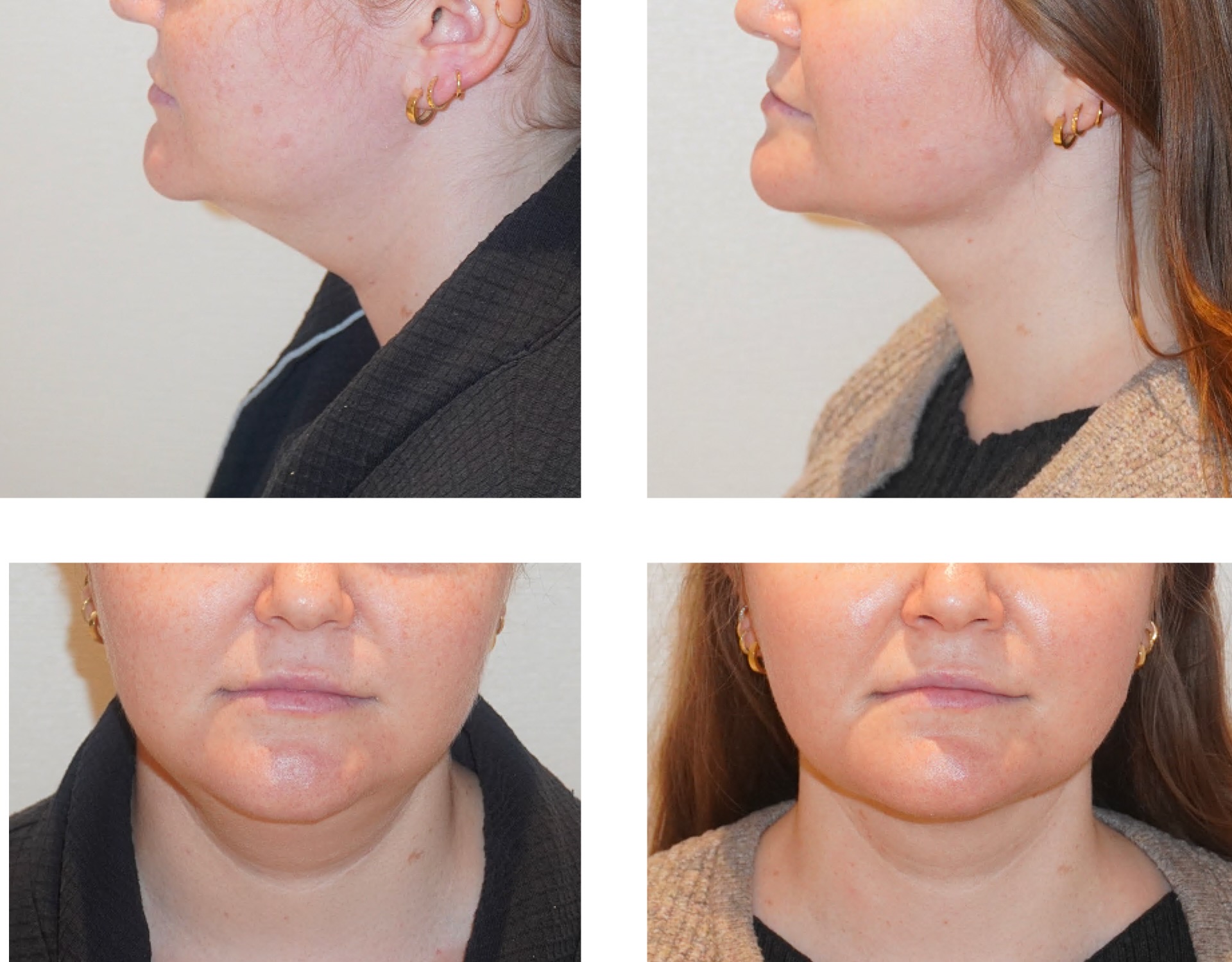 Chin liposuction photographs, Screenshot 2025-12-09 at 12.36.30 PM.