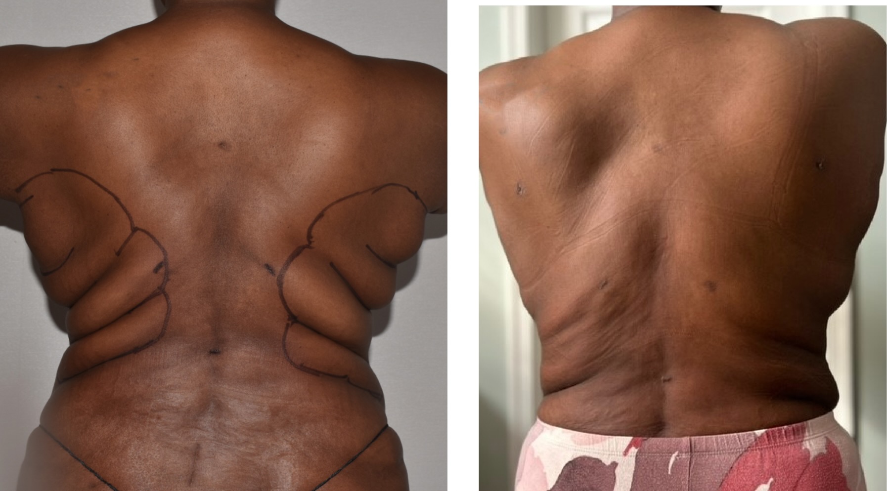 Back liposuction photographs, Photo 104.