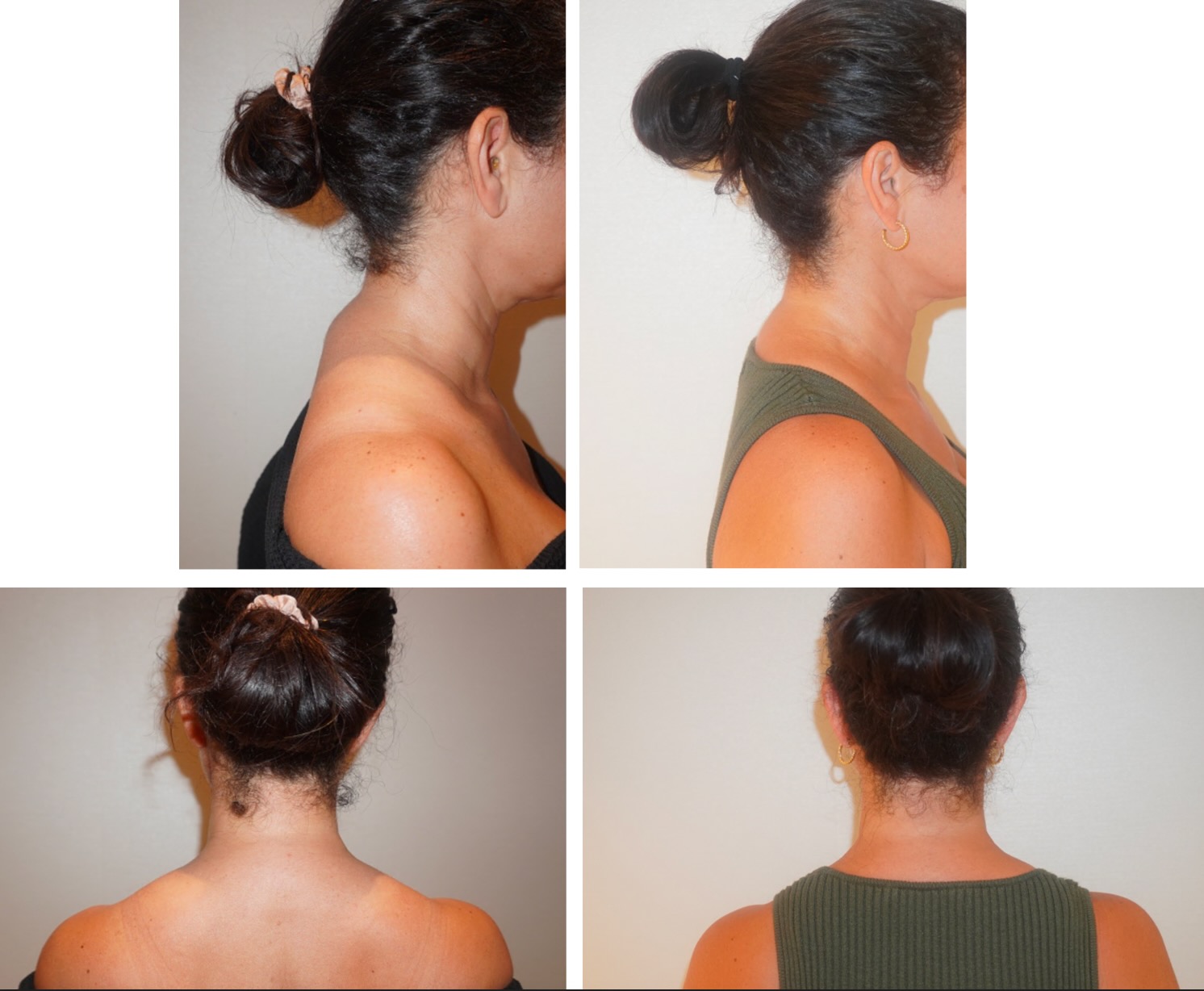 Dorsal Cervical Fat Pad (Buffalo Hump) photographs, Photo 95.