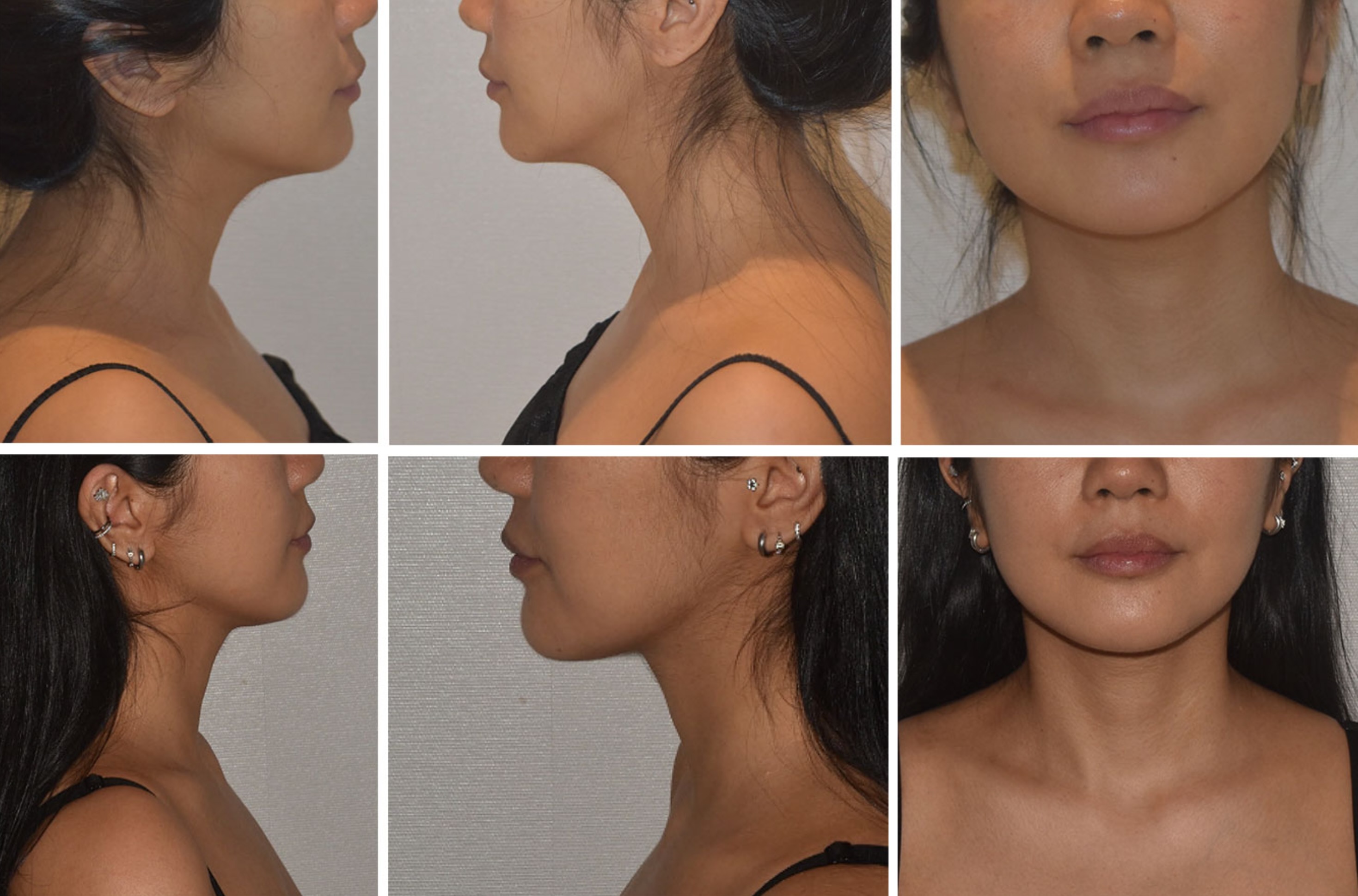 Chin liposuction photographs, Photo 168.