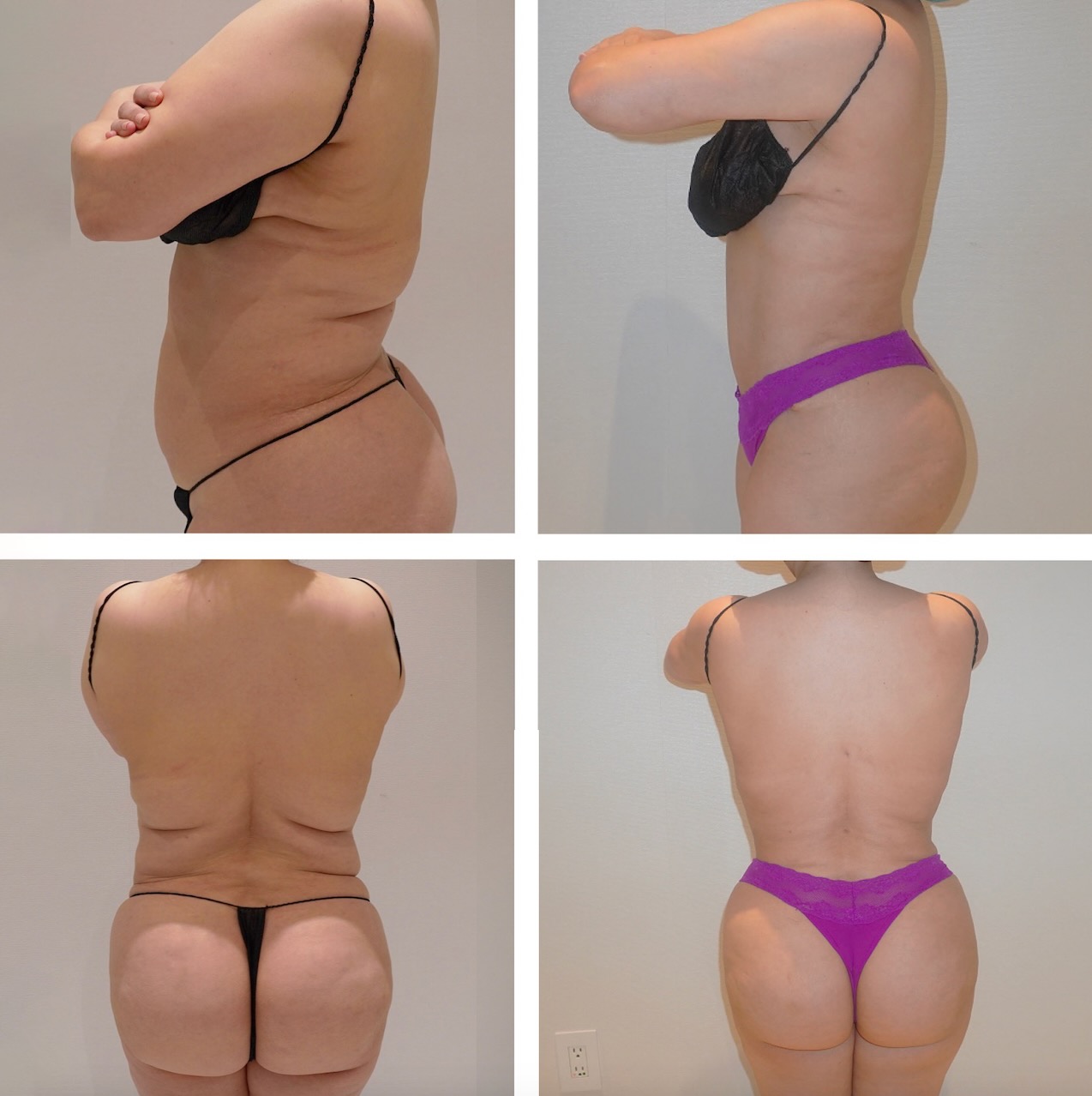 Back liposuction photographs, Photo 110.