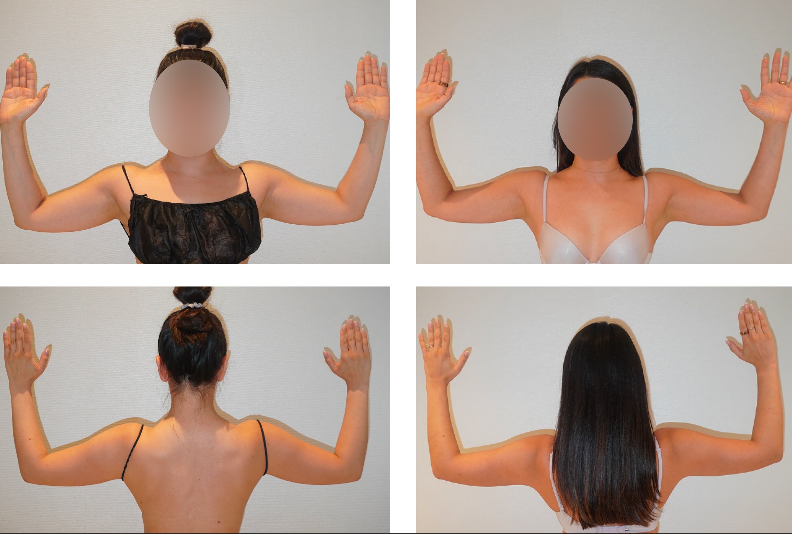 Arm liposuction photographs, b19.