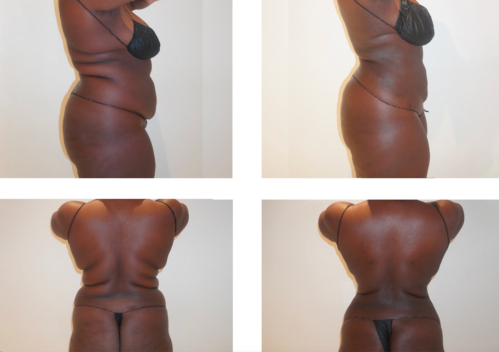 Back liposuction photographs, Photo 111.