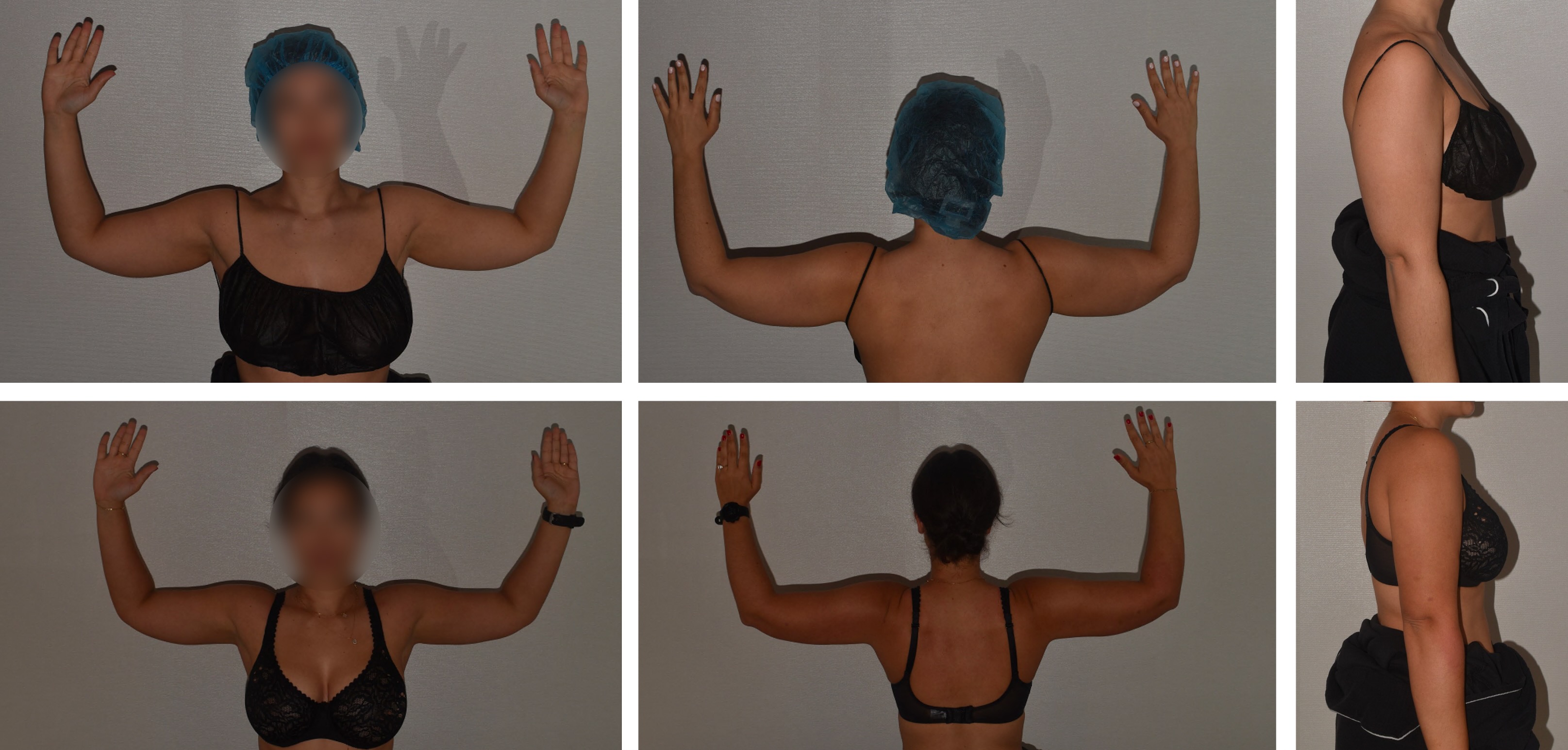 Arm liposuction photographs, Photo 108.