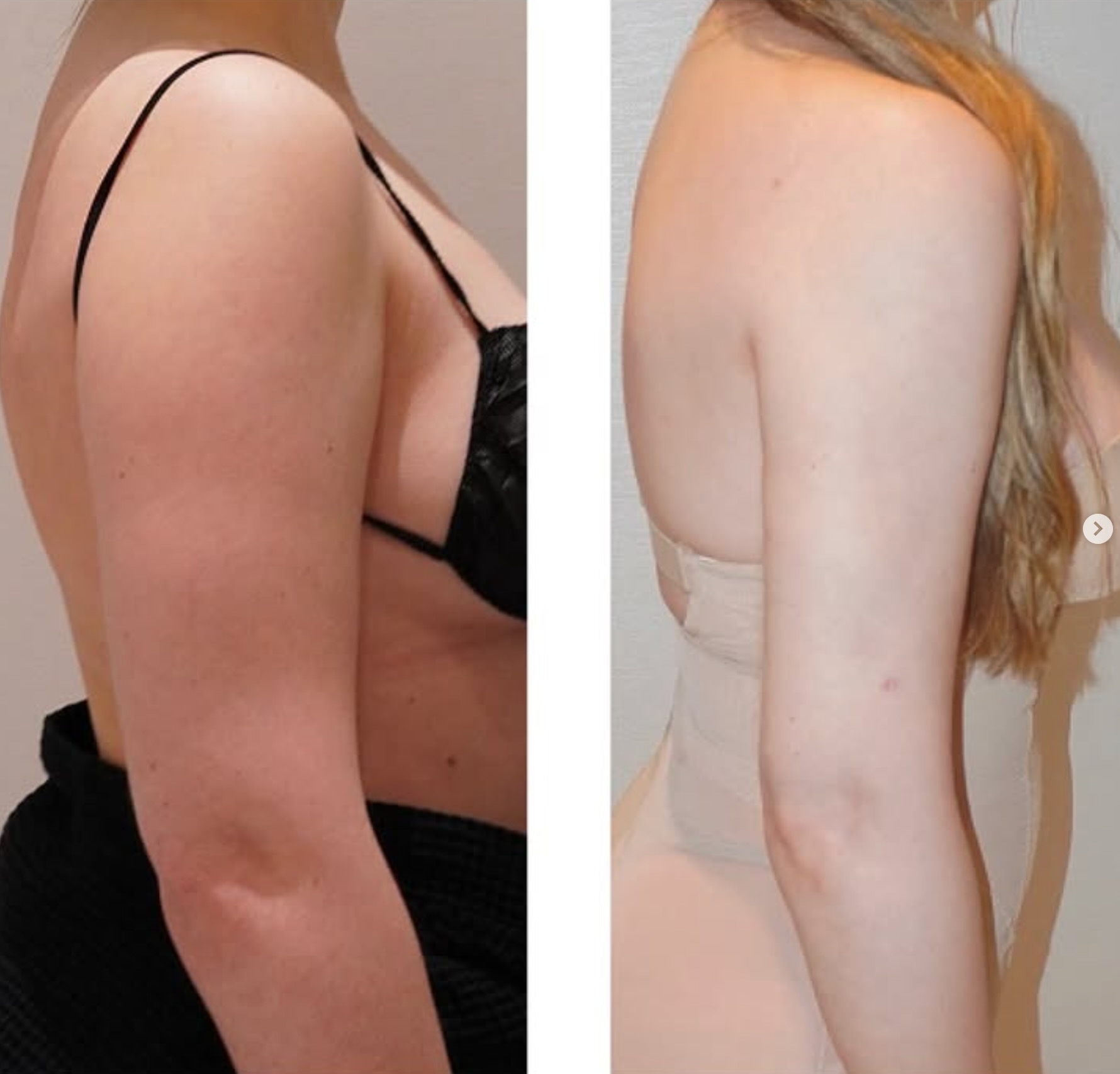 Arm liposuction photographs, Photo 128.