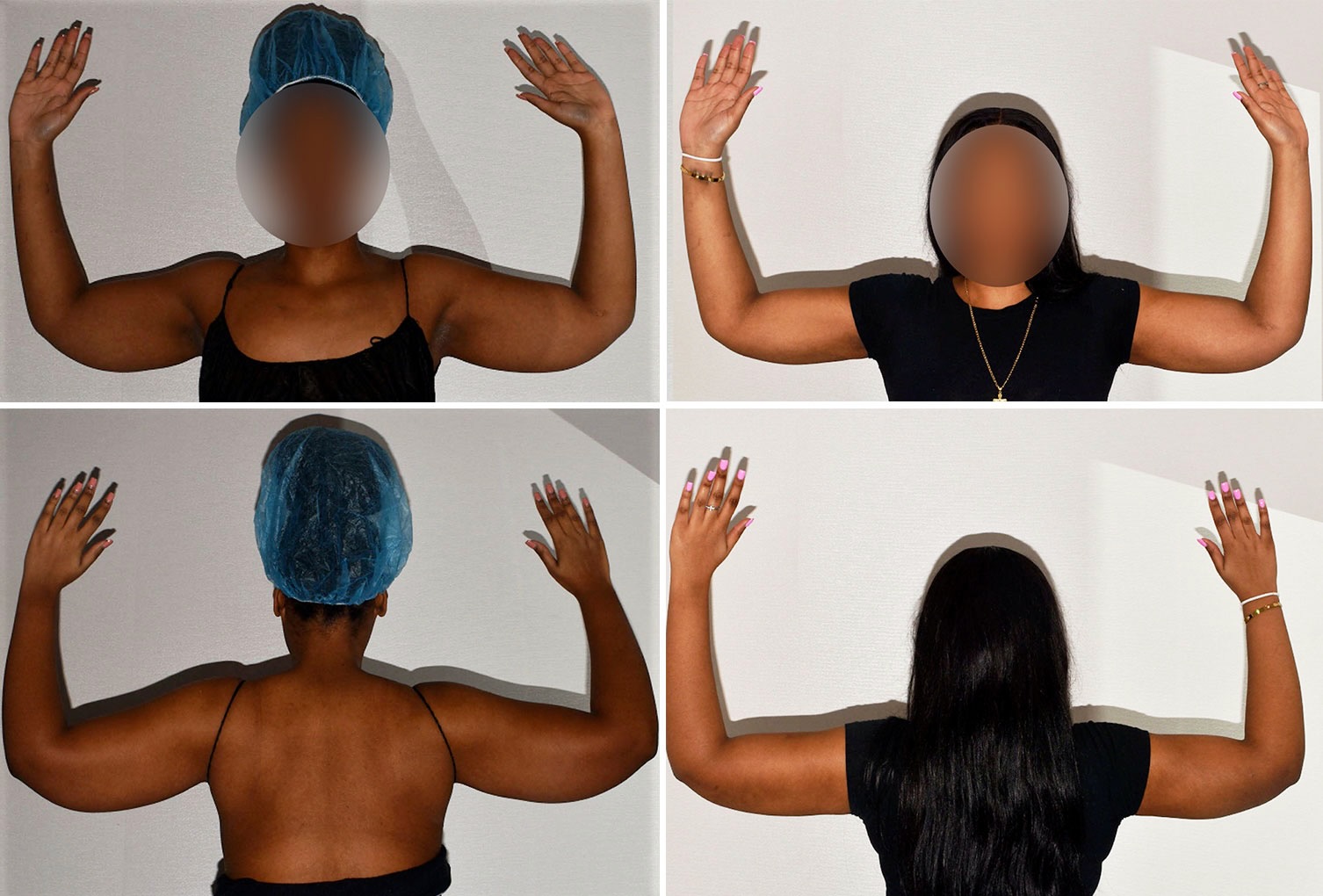 Arm liposuction photographs, Photo 178.