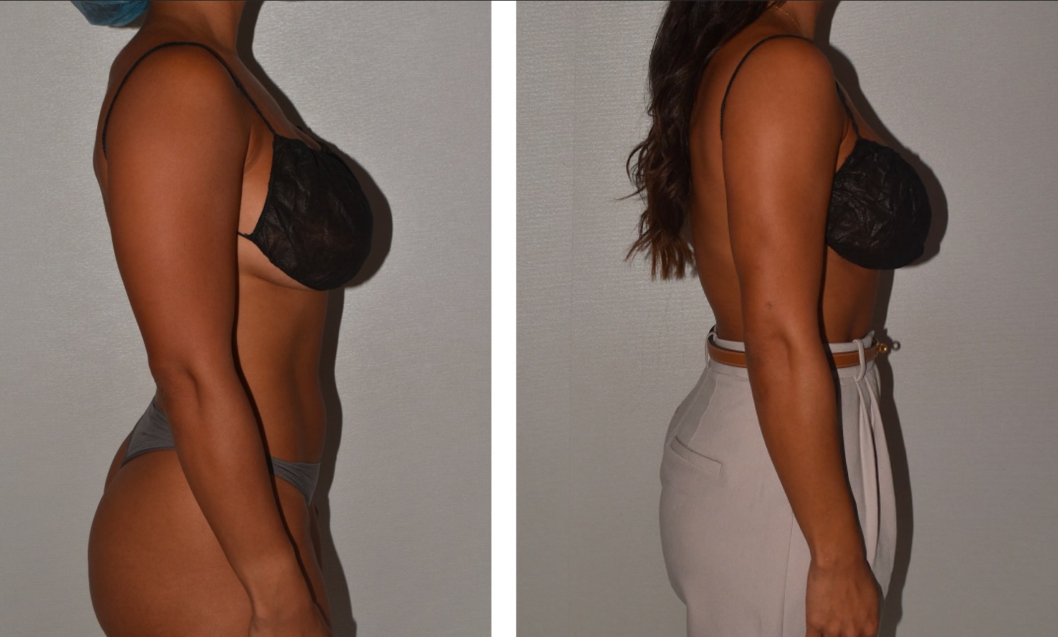 Arm liposuction photographs, Photo a6.