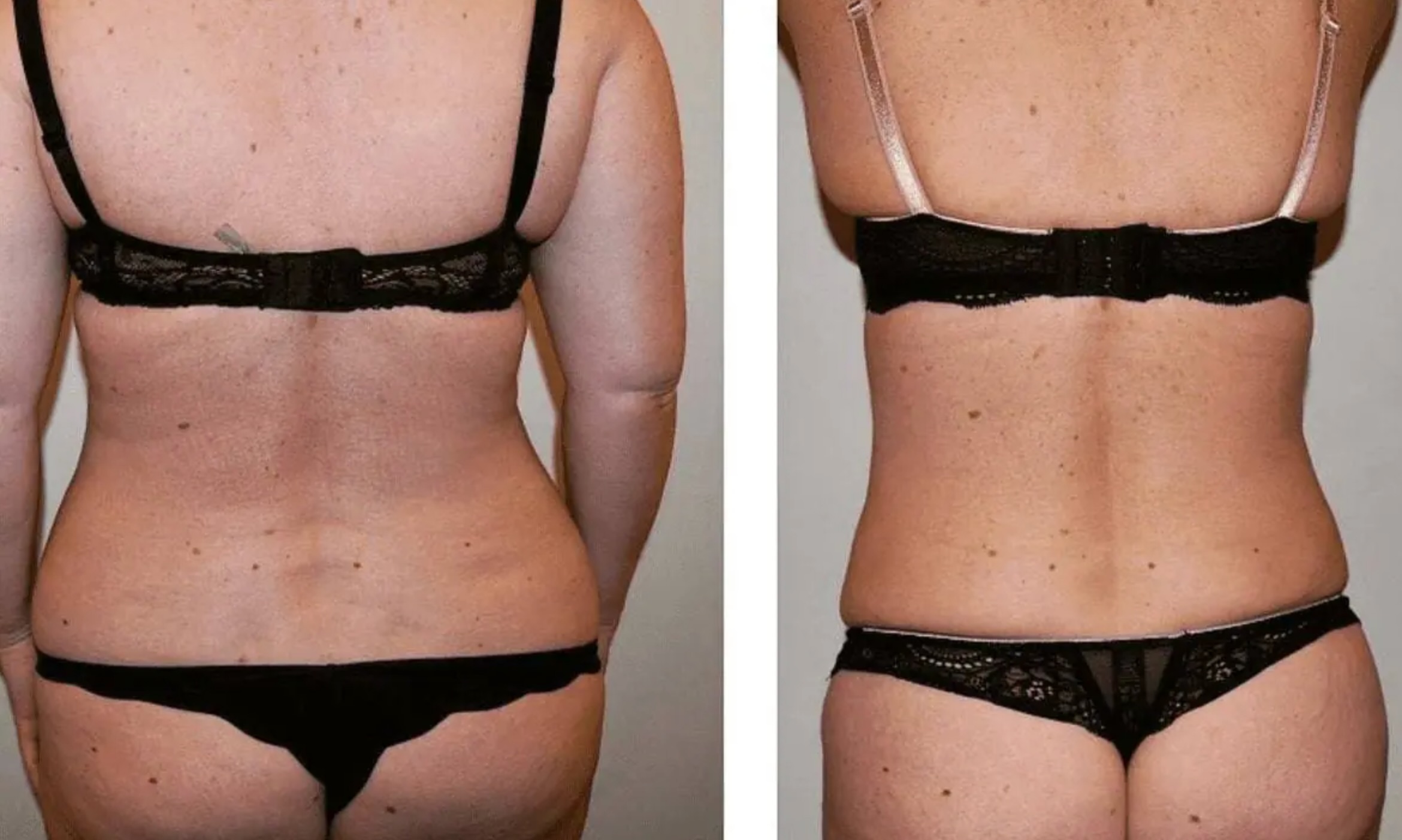 Back liposuction photographs, Photo 115.