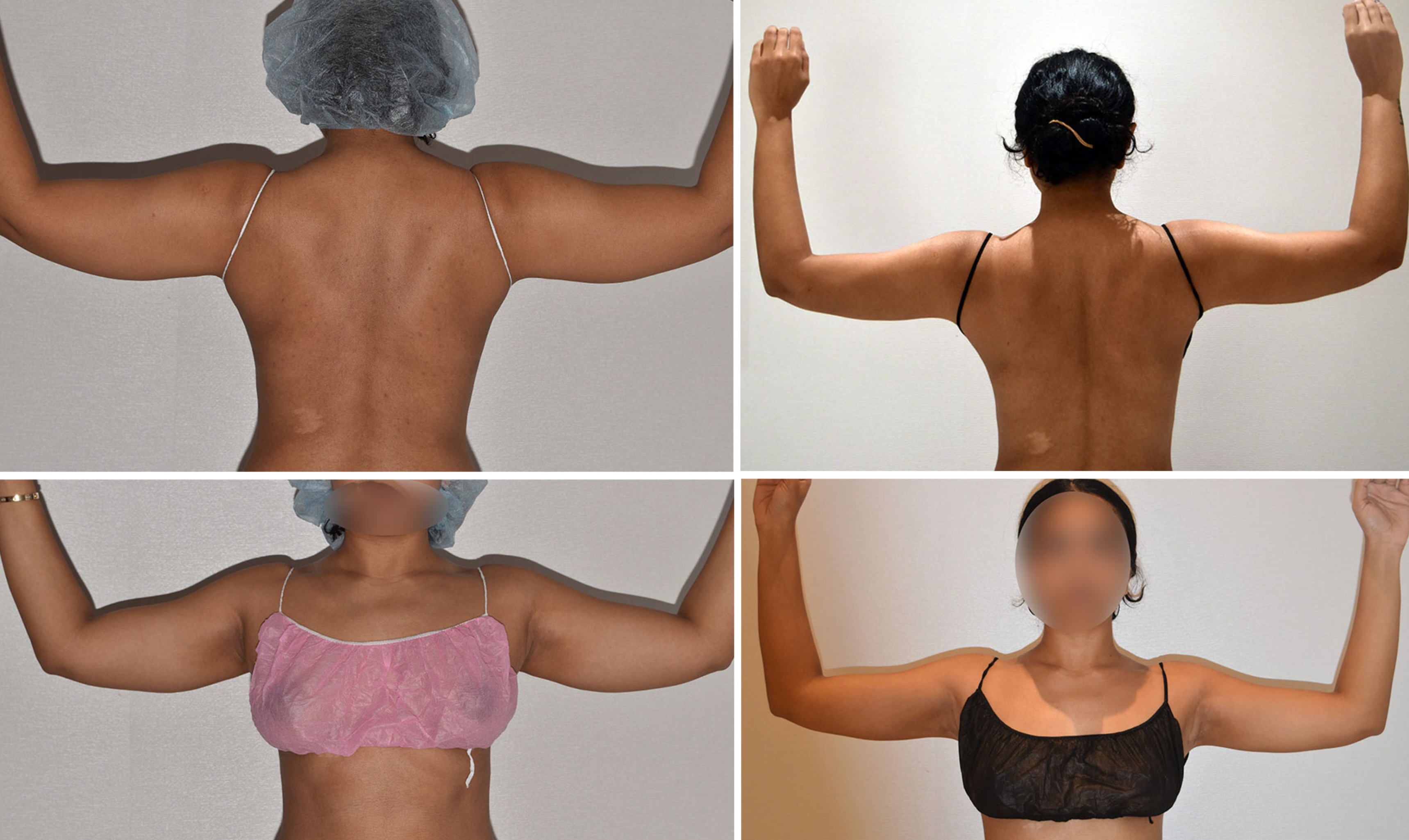 Arm liposuction photographs, Photo 166.