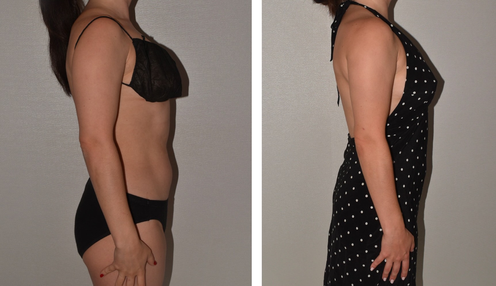 Arm liposuction photographs, Photo a7.