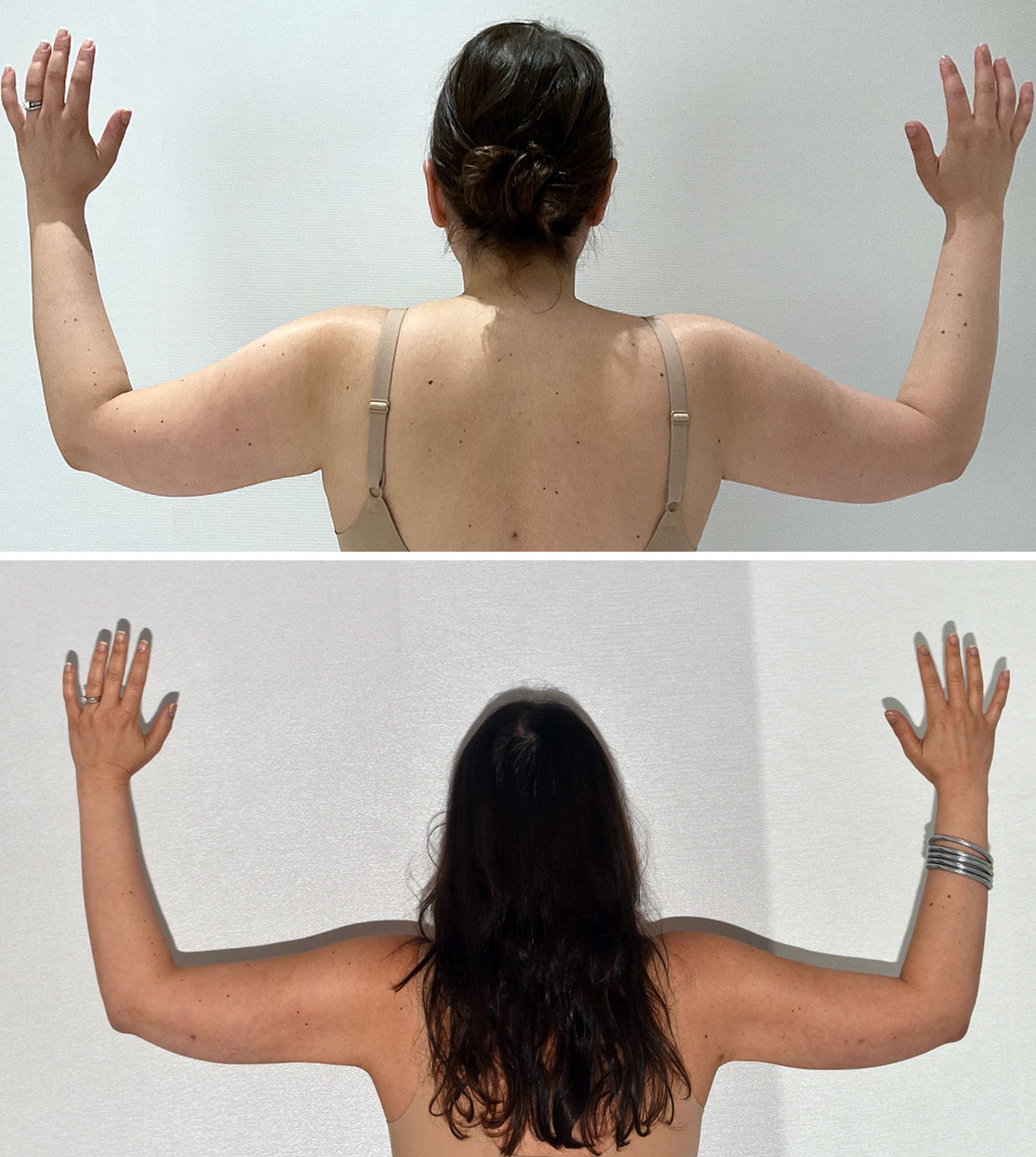 Arm liposuction photographs, Photo 165.