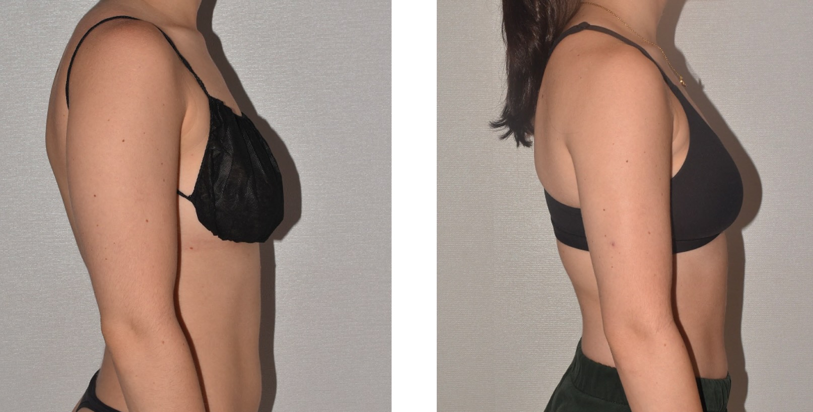 Arm liposuction photographs, Photo a8.