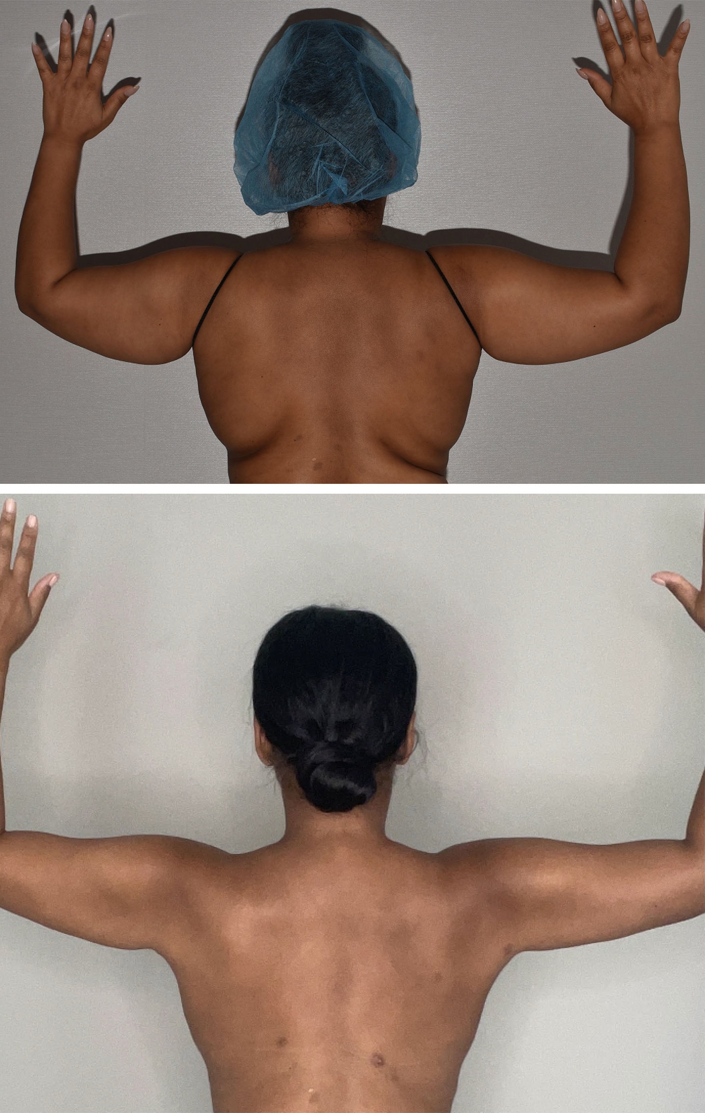 Arm liposuction photographs, Photo 177.