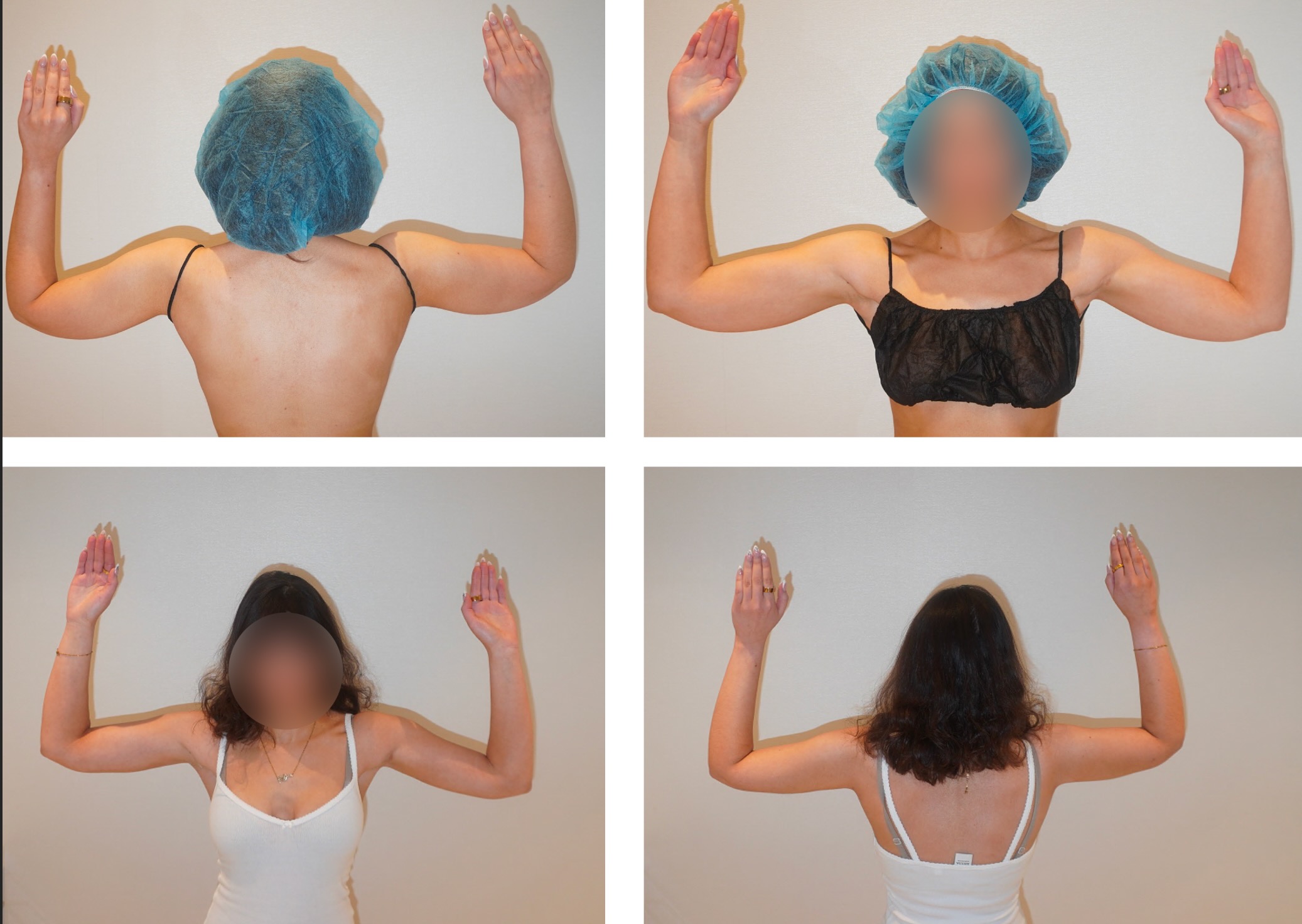 Arm liposuction photographs, Screenshot 2026-01-09 at 2.51.27 PM.