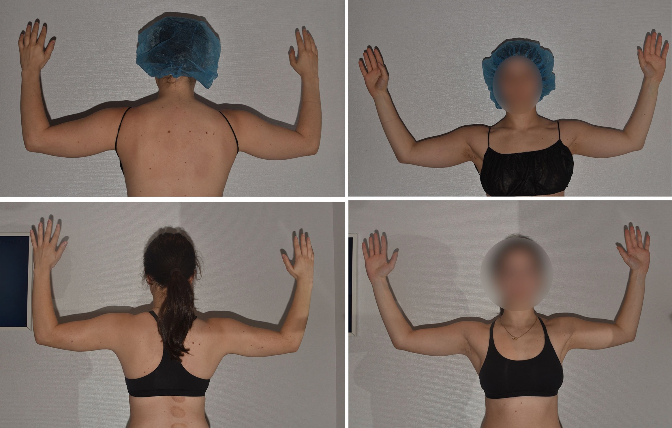 Arm liposuction photographs, Photo 179.