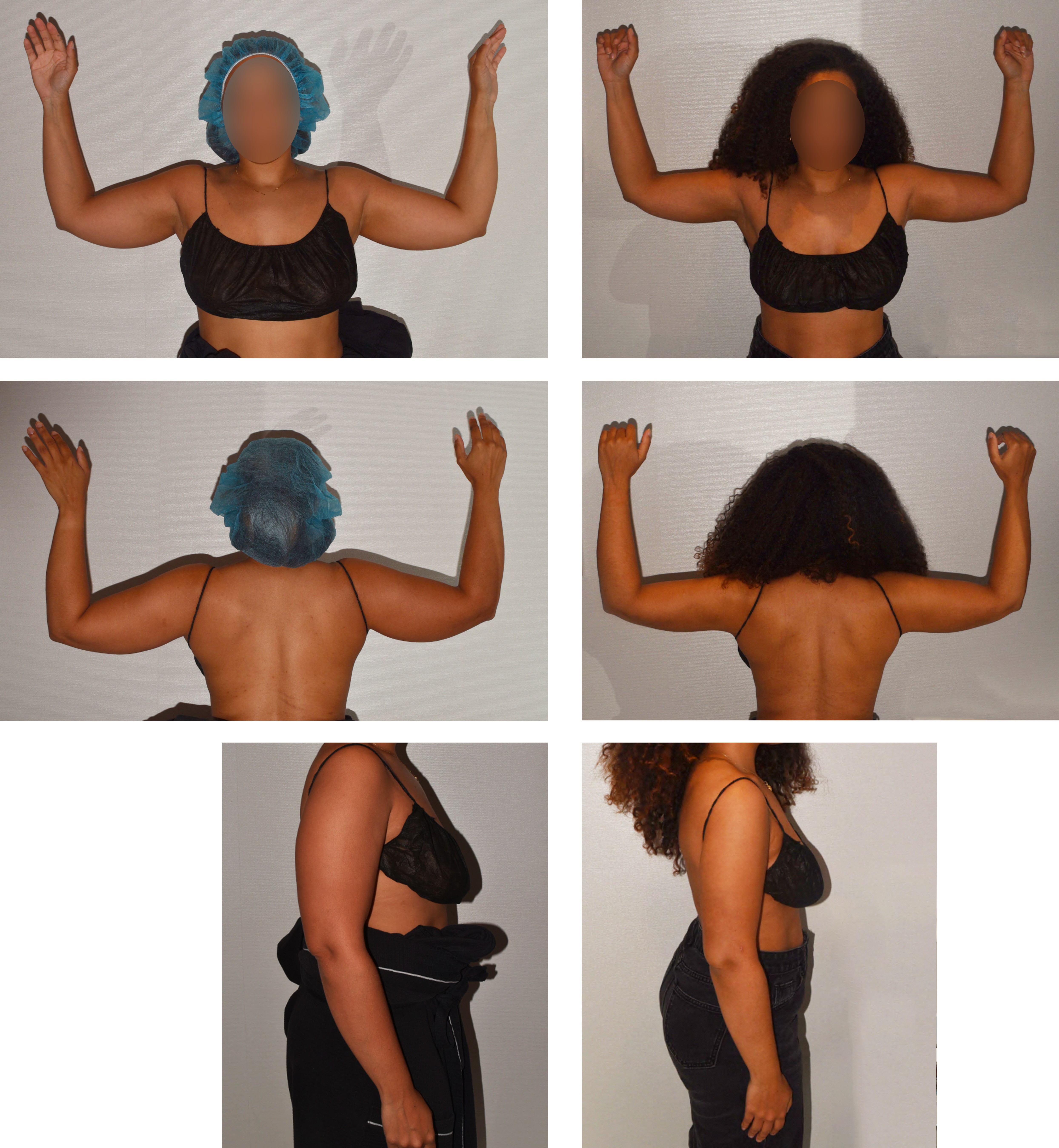 Arm liposuction photographs, Photo 181.