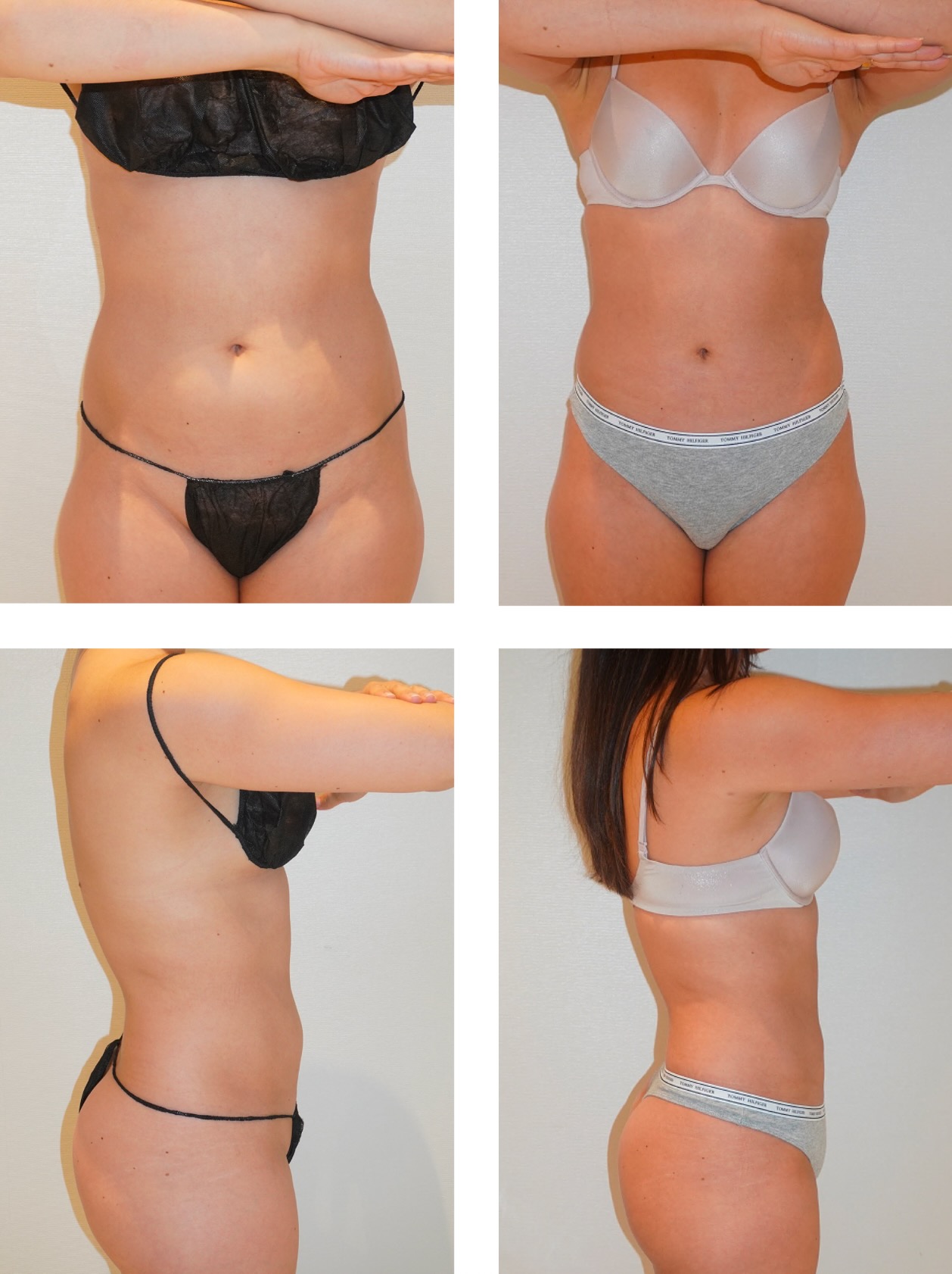 Abdomen, Waist, and Lipo 360 photographs, b18.