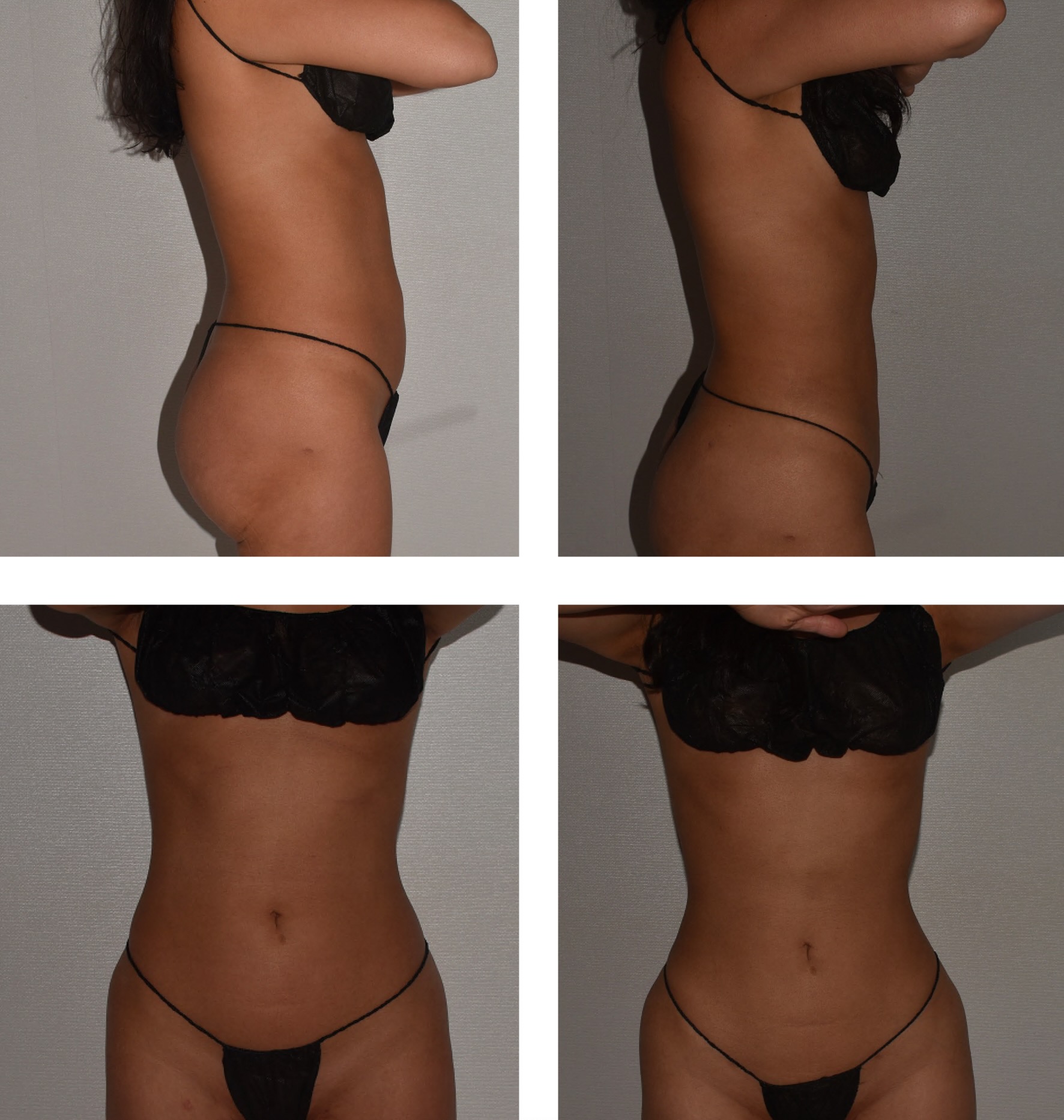 Abdomen, Waist, and Lipo 360 photographs, Photo 21.