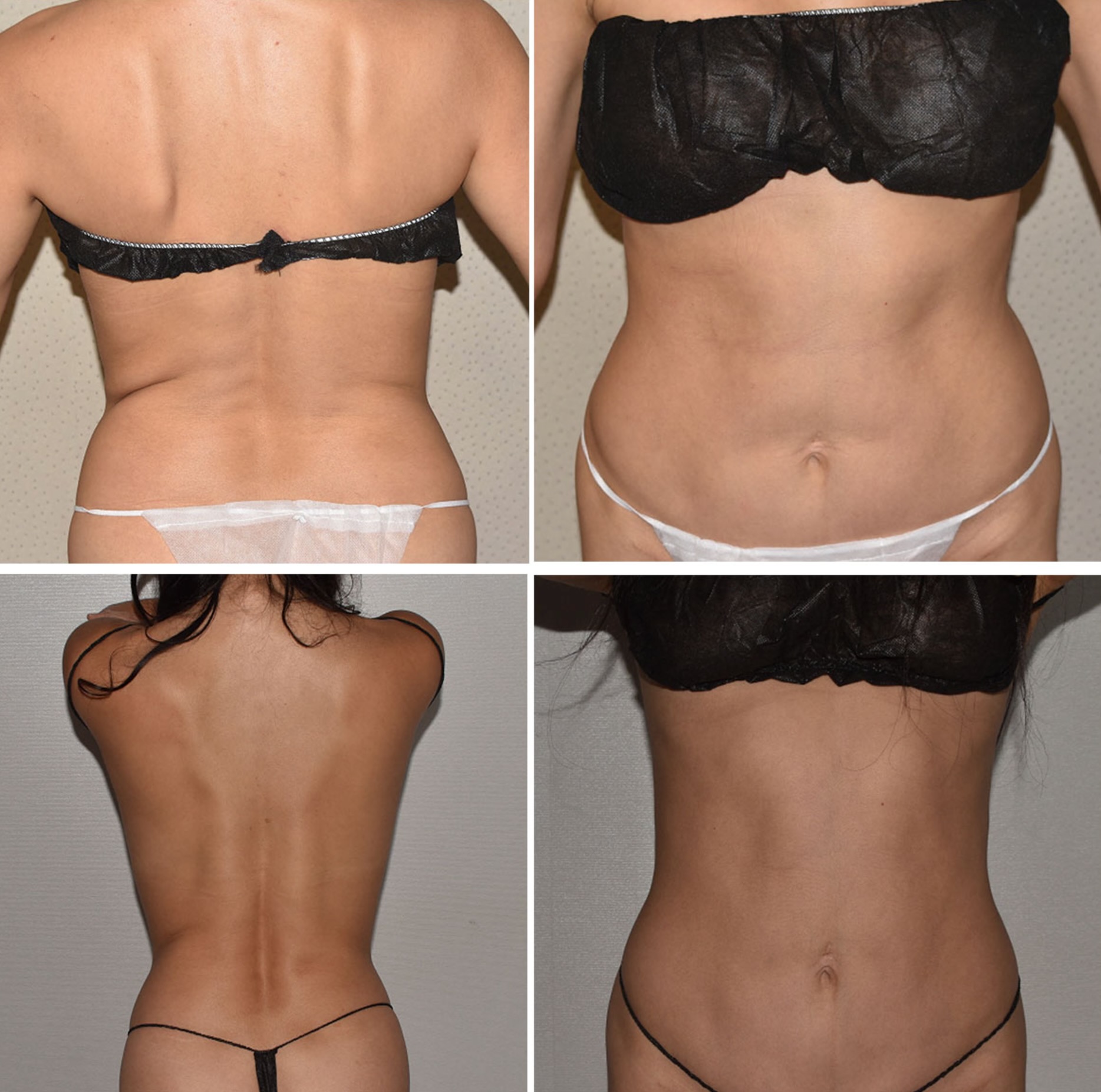 Abdomen, Waist, and Lipo 360 photographs, Photo 9.