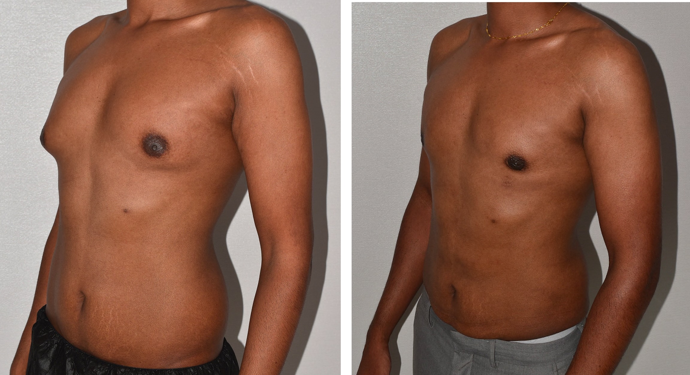 Abdomen, Waist, and Lipo 360 photographs, Photo 24.