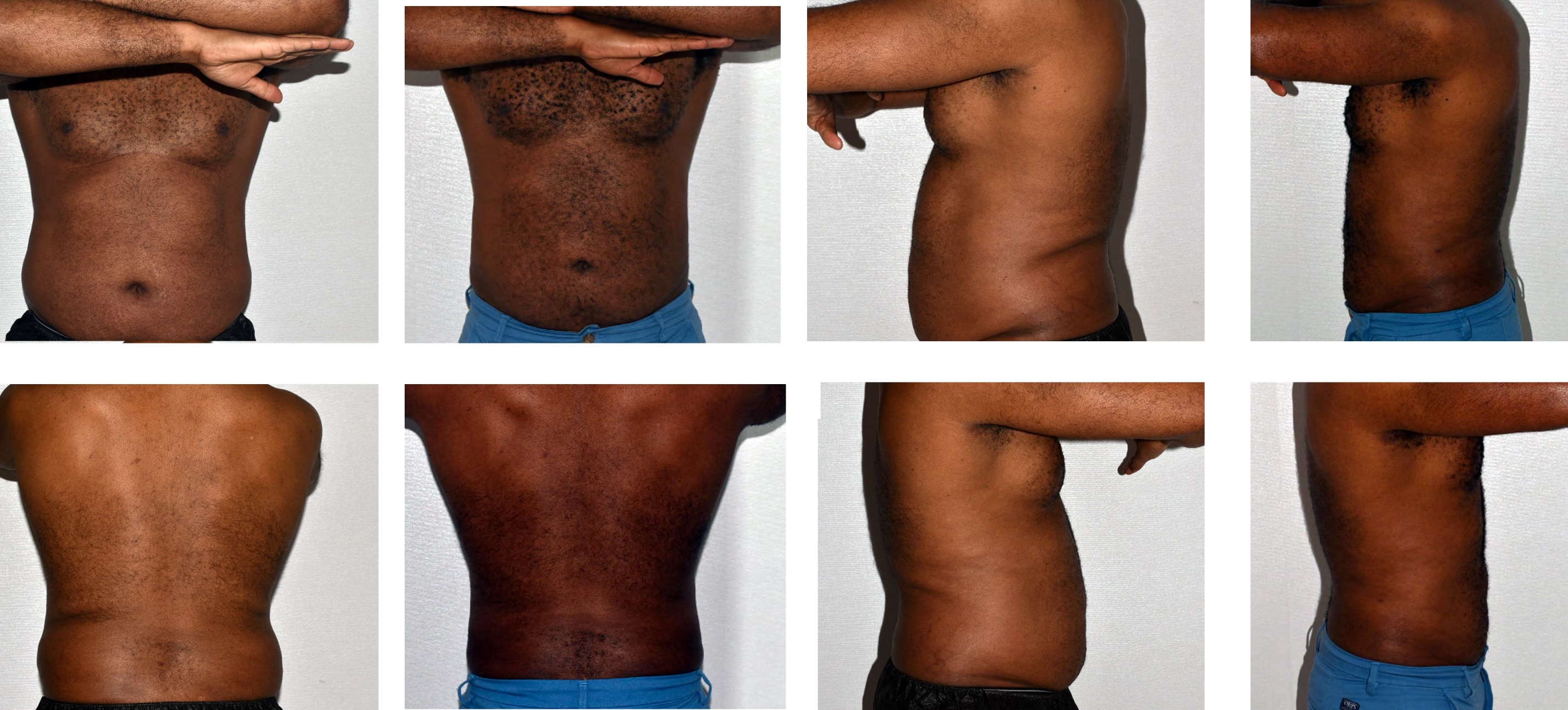 Abdomen, Waist, and Lipo 360 photographs, Photo 20.