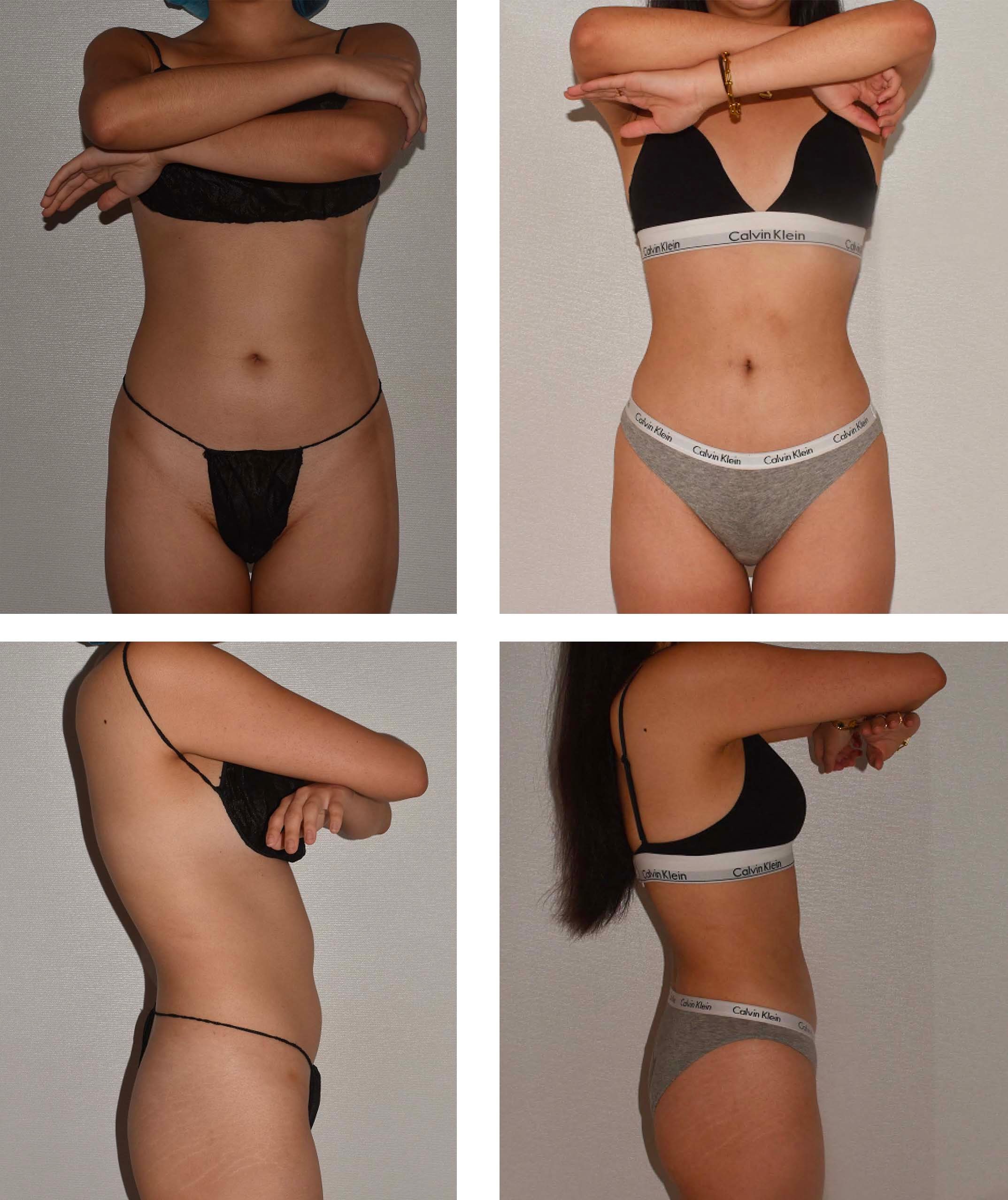 Abdomen, Waist, and Lipo 360 photographs, Photo 3.