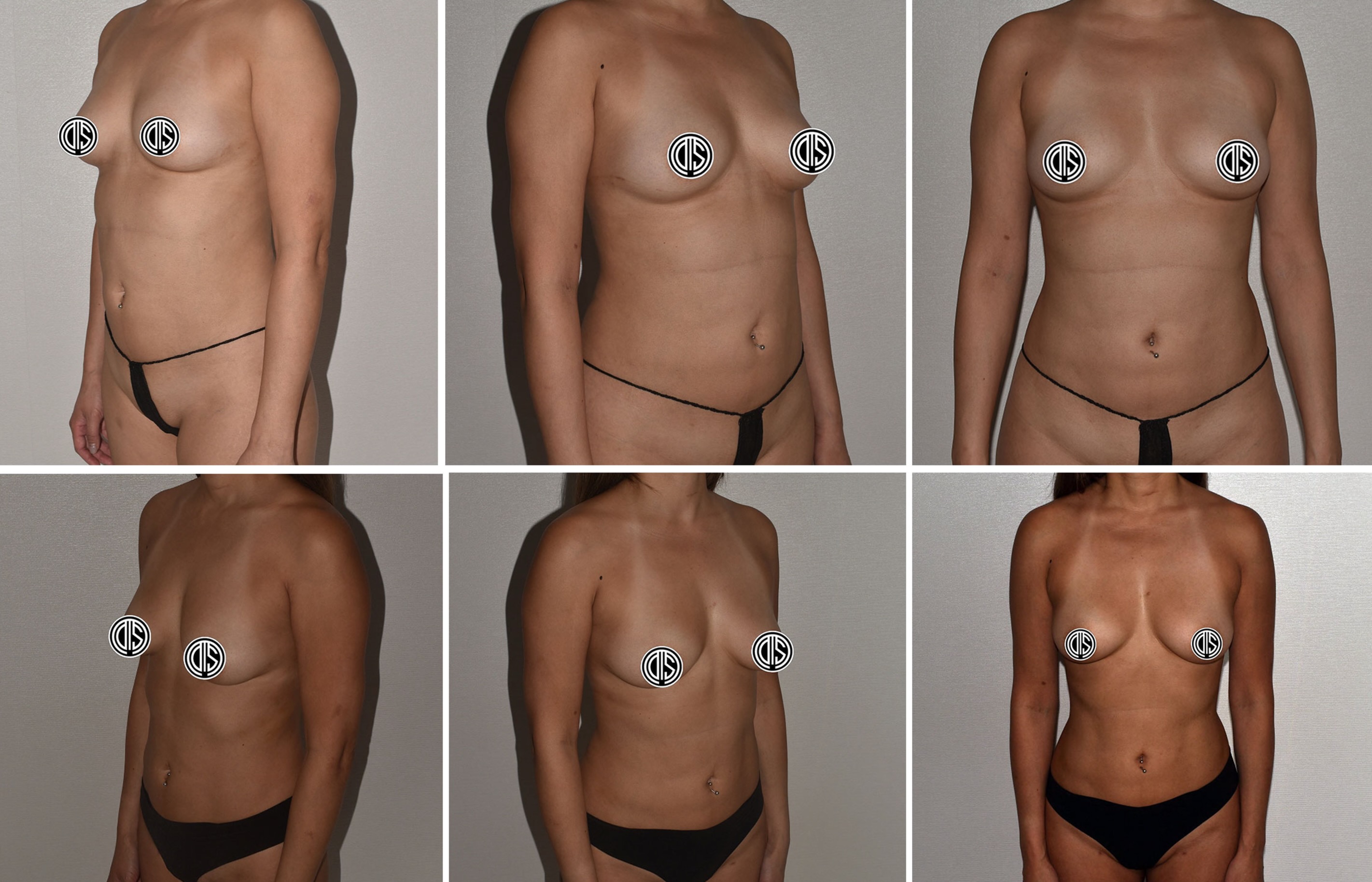 Abdomen, Waist, and Lipo 360 photographs, Photo 10.
