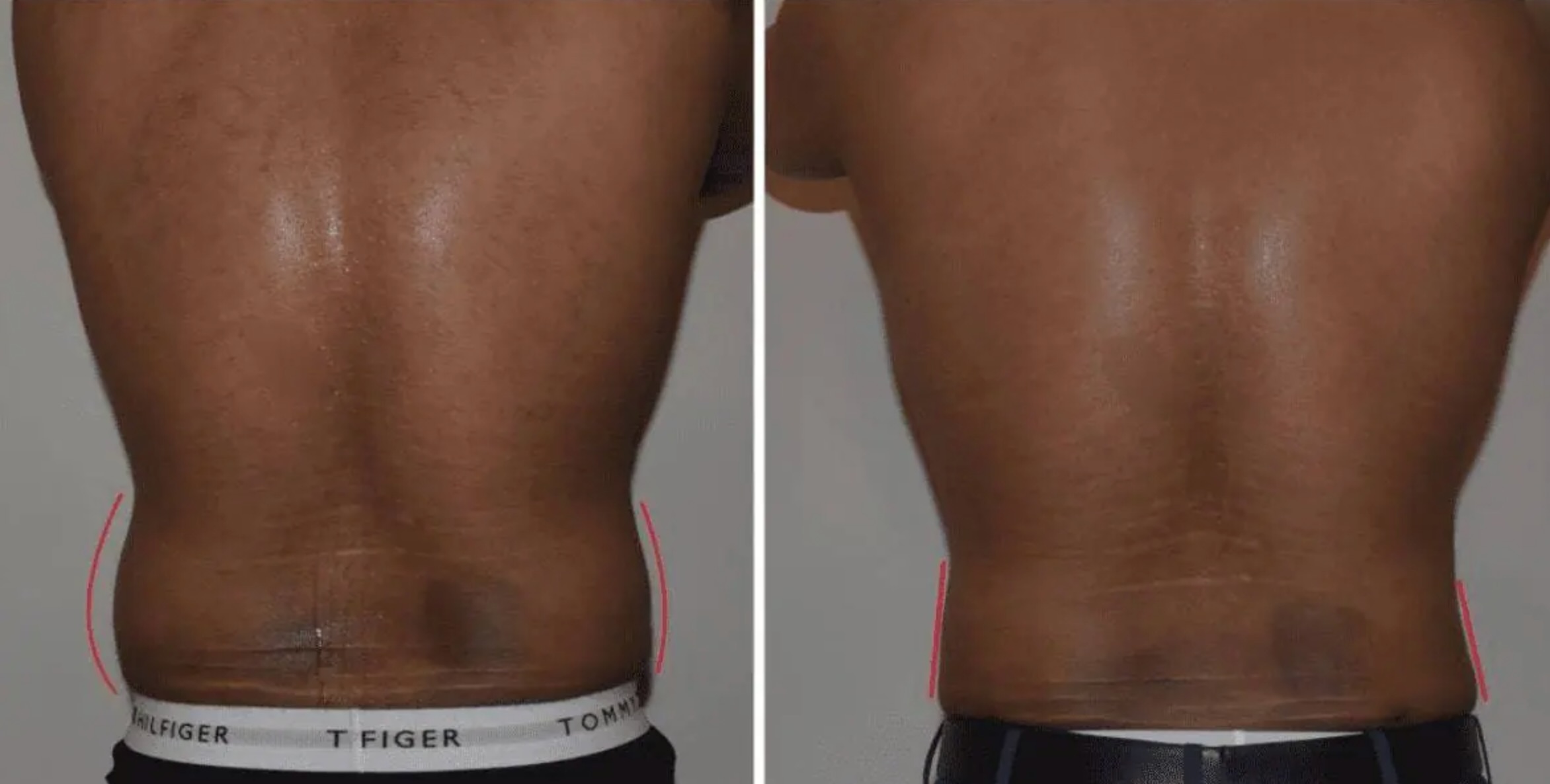 Abdomen, Waist, and Lipo 360 photographs, Photo 29.