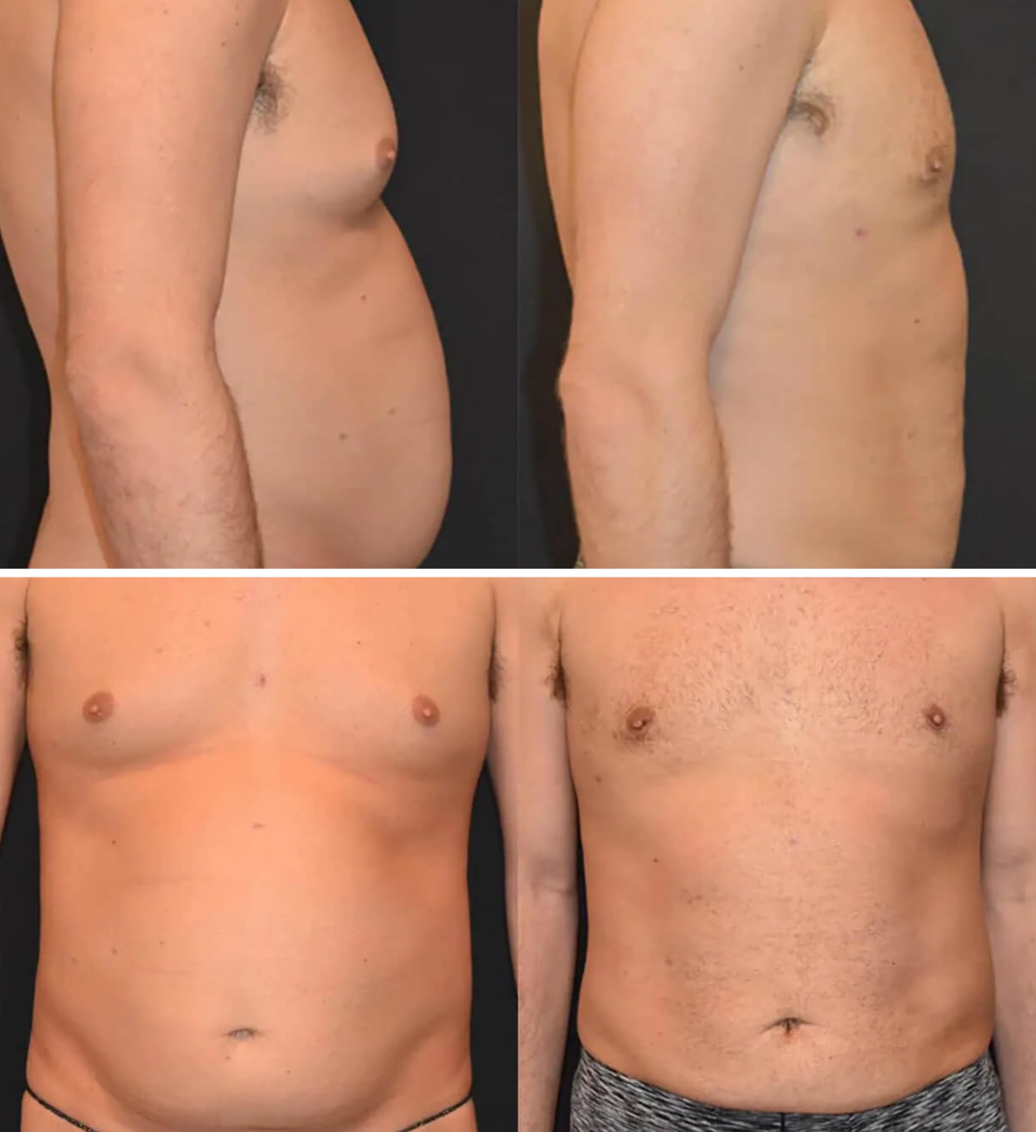 Abdomen, Waist, and Lipo 360 photographs, Photo 27.