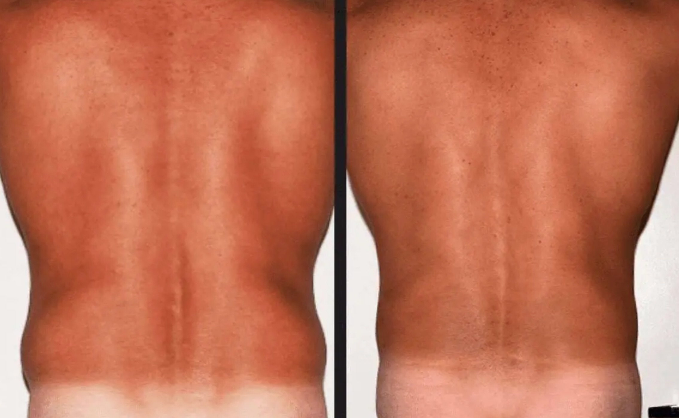 Abdomen, Waist, and Lipo 360 photographs, Photo 28.