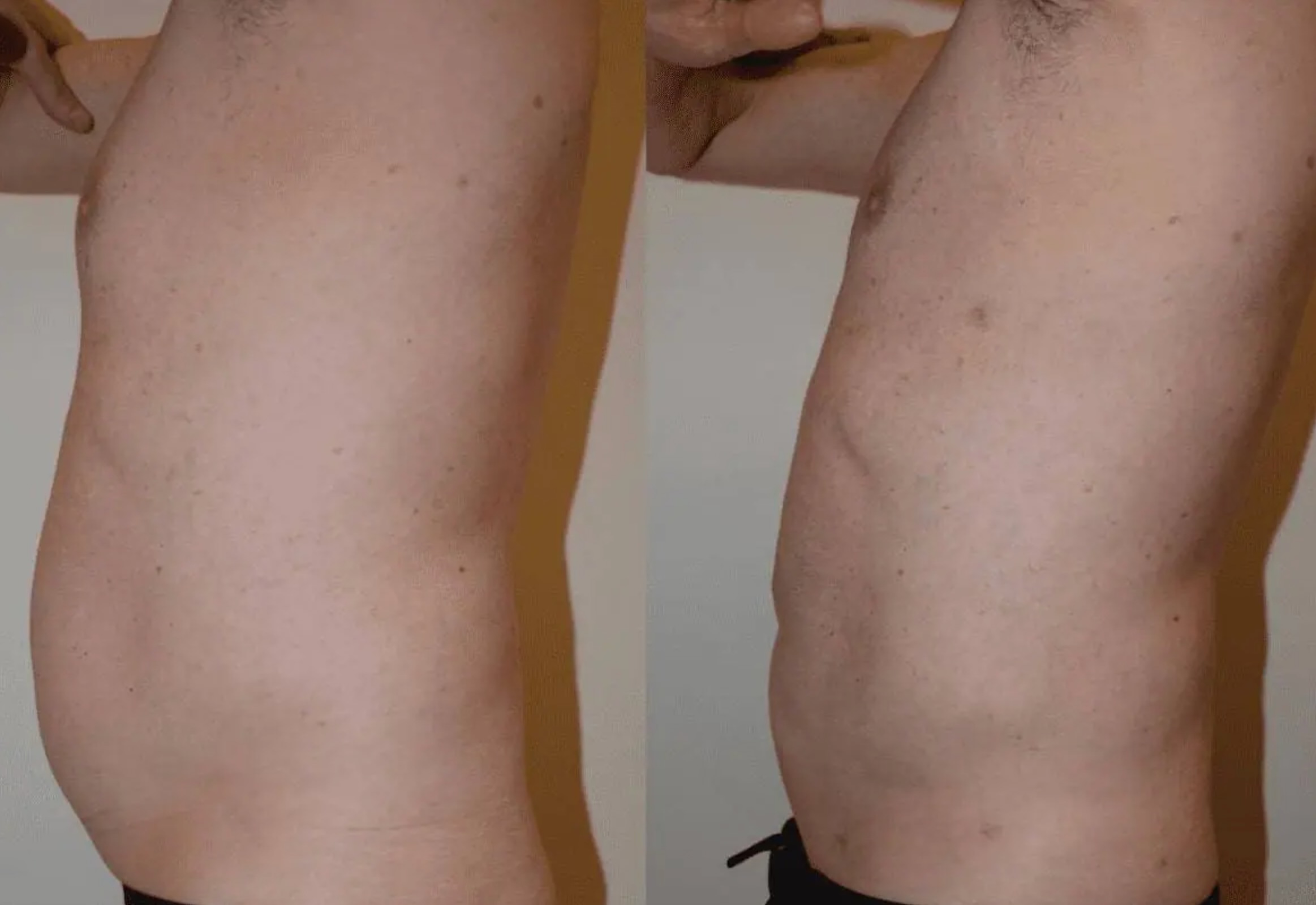 Abdomen, Waist, and Lipo 360 photographs, Photo 64.