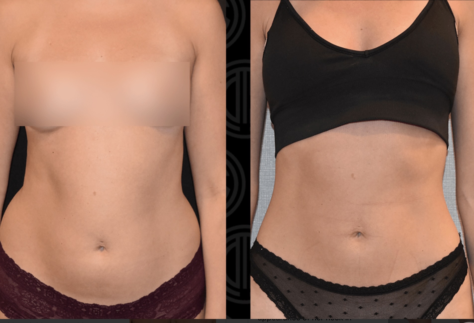 Abdomen, Waist, and Lipo 360 photographs, Photo 63.